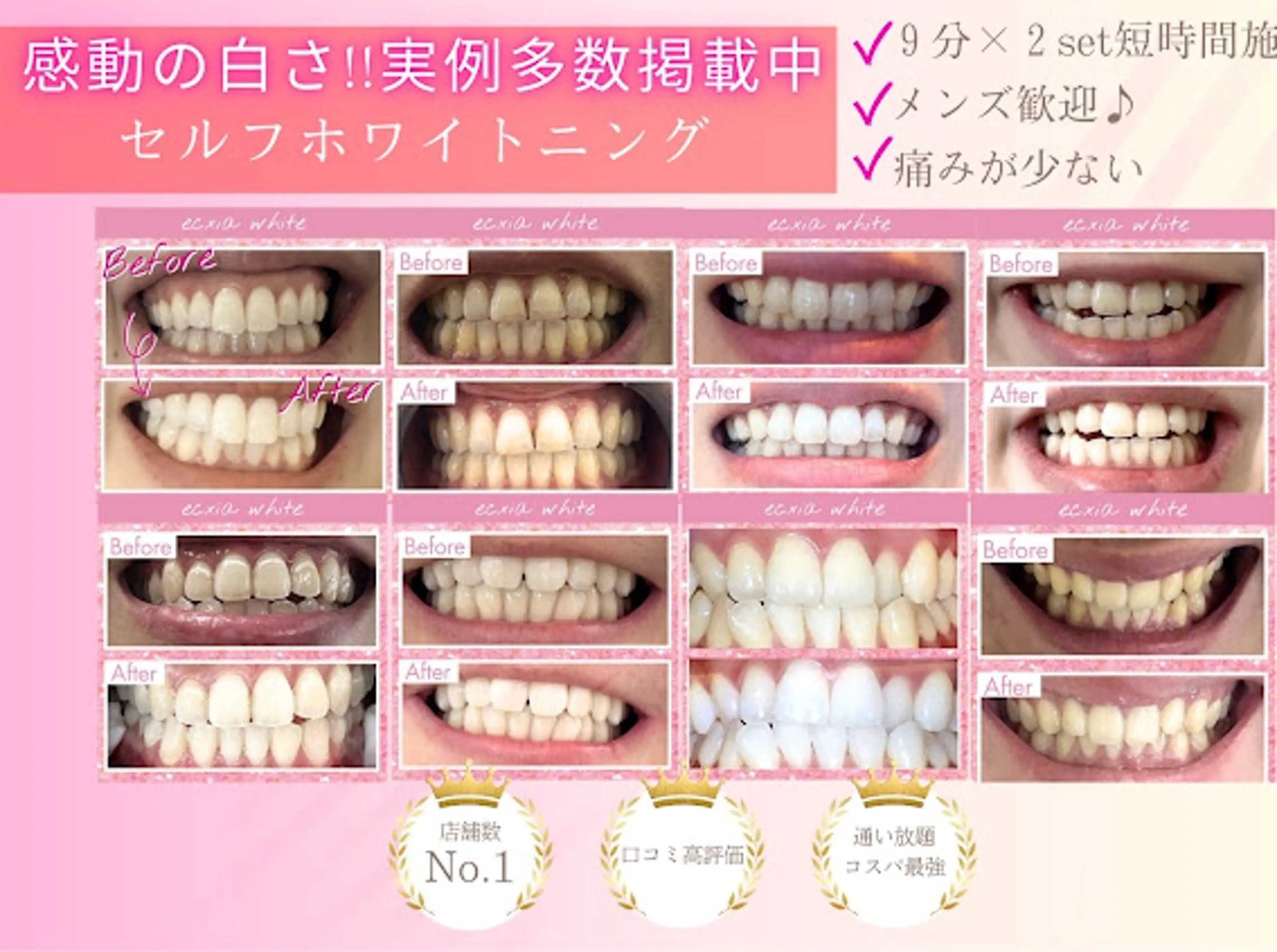 セルフホワイトニング(9分×2セット)¥3980→¥500の写真