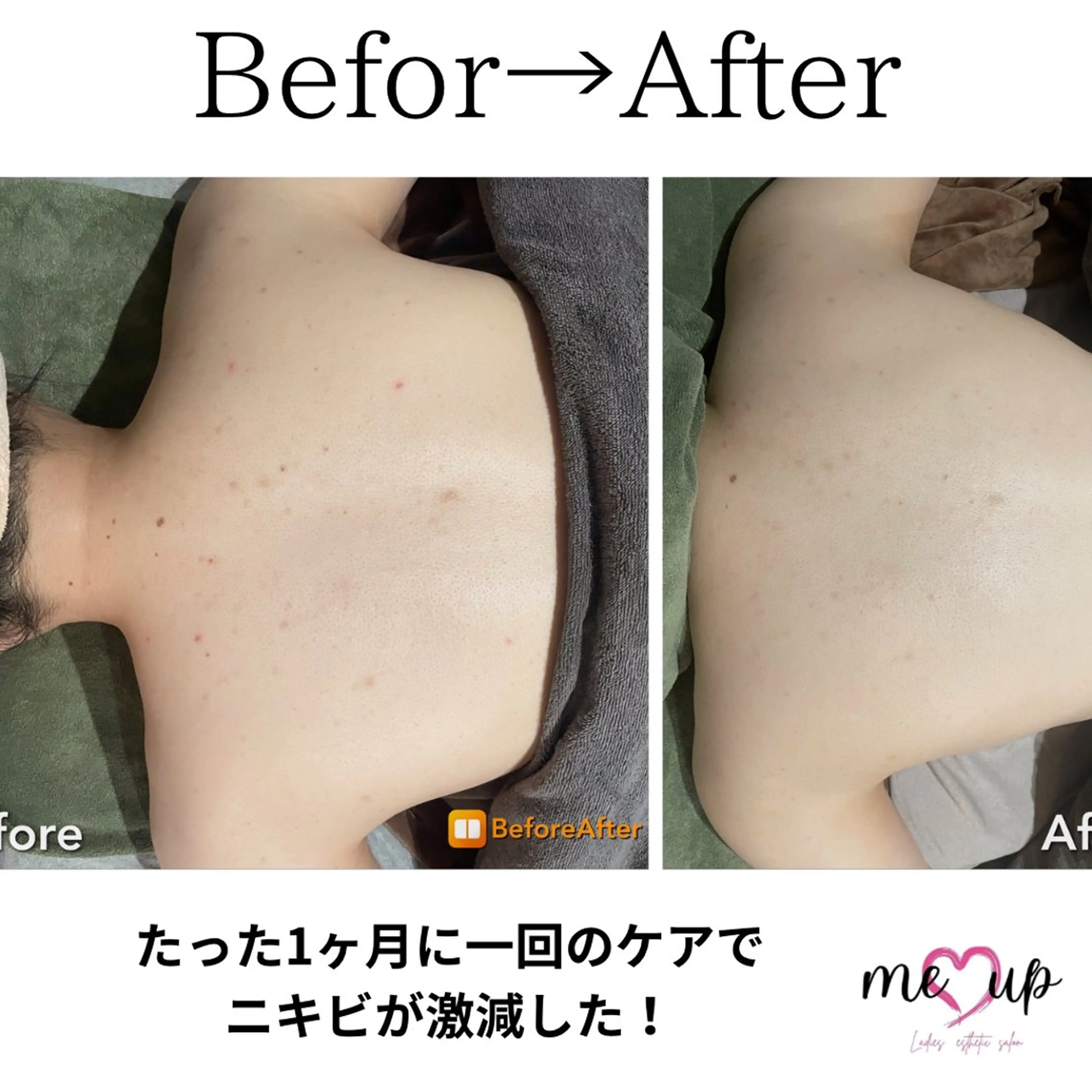 エステ Meupニキビ専門店 背中/ハーブ/肌管理のその他イメージ