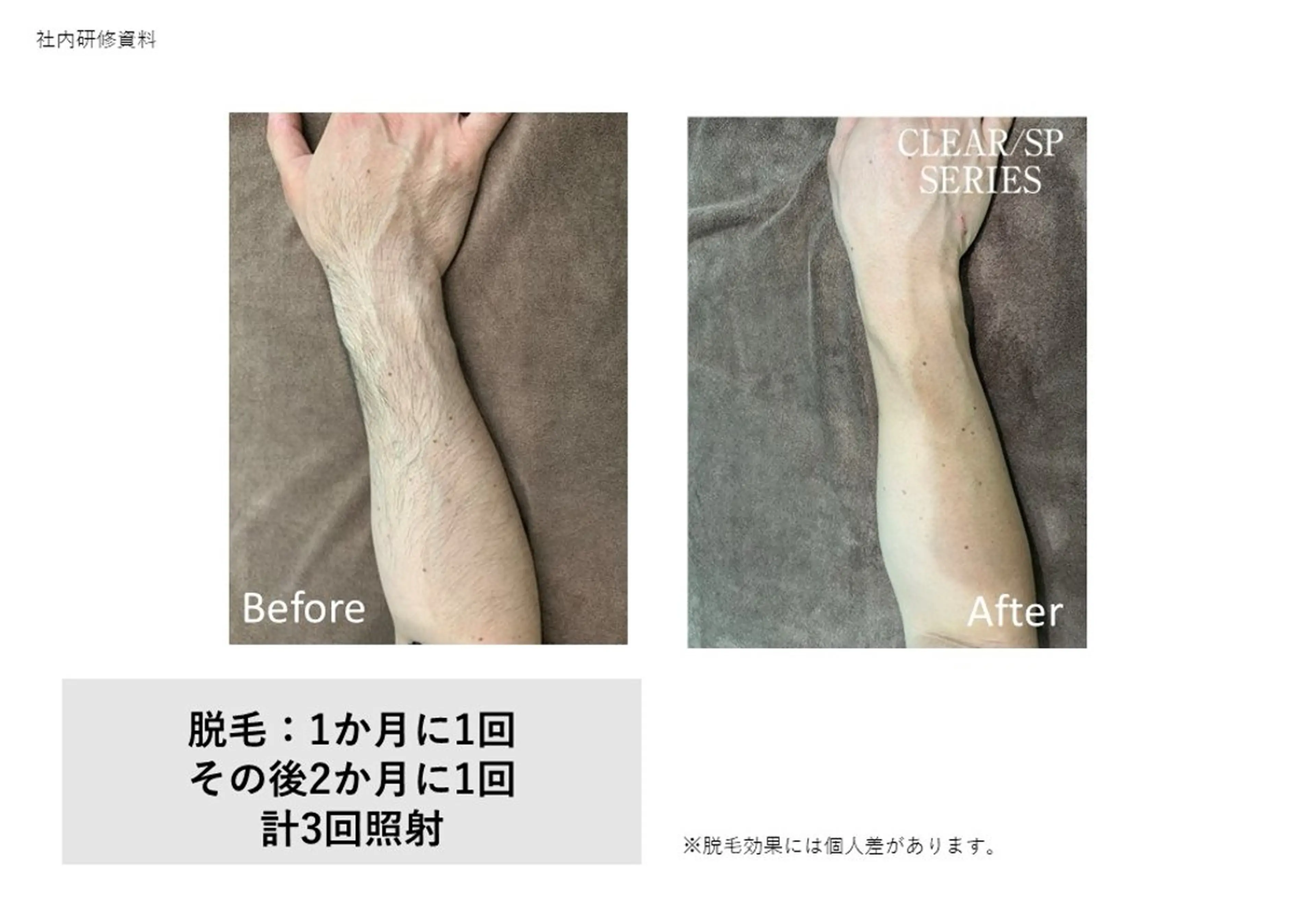 両腕(甲・指込み)セットの写真