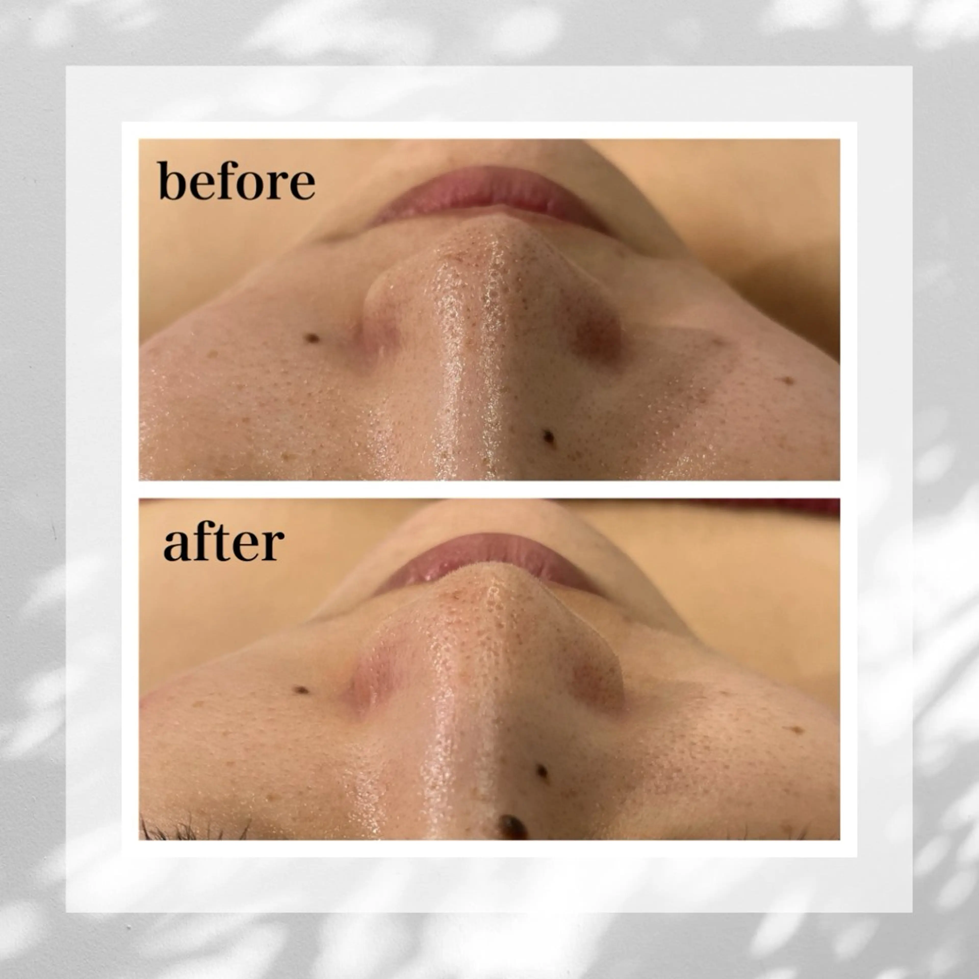 エステ フローフシ∞💙 毛穴洗浄で毛穴レスのエステ・リラクイメージ