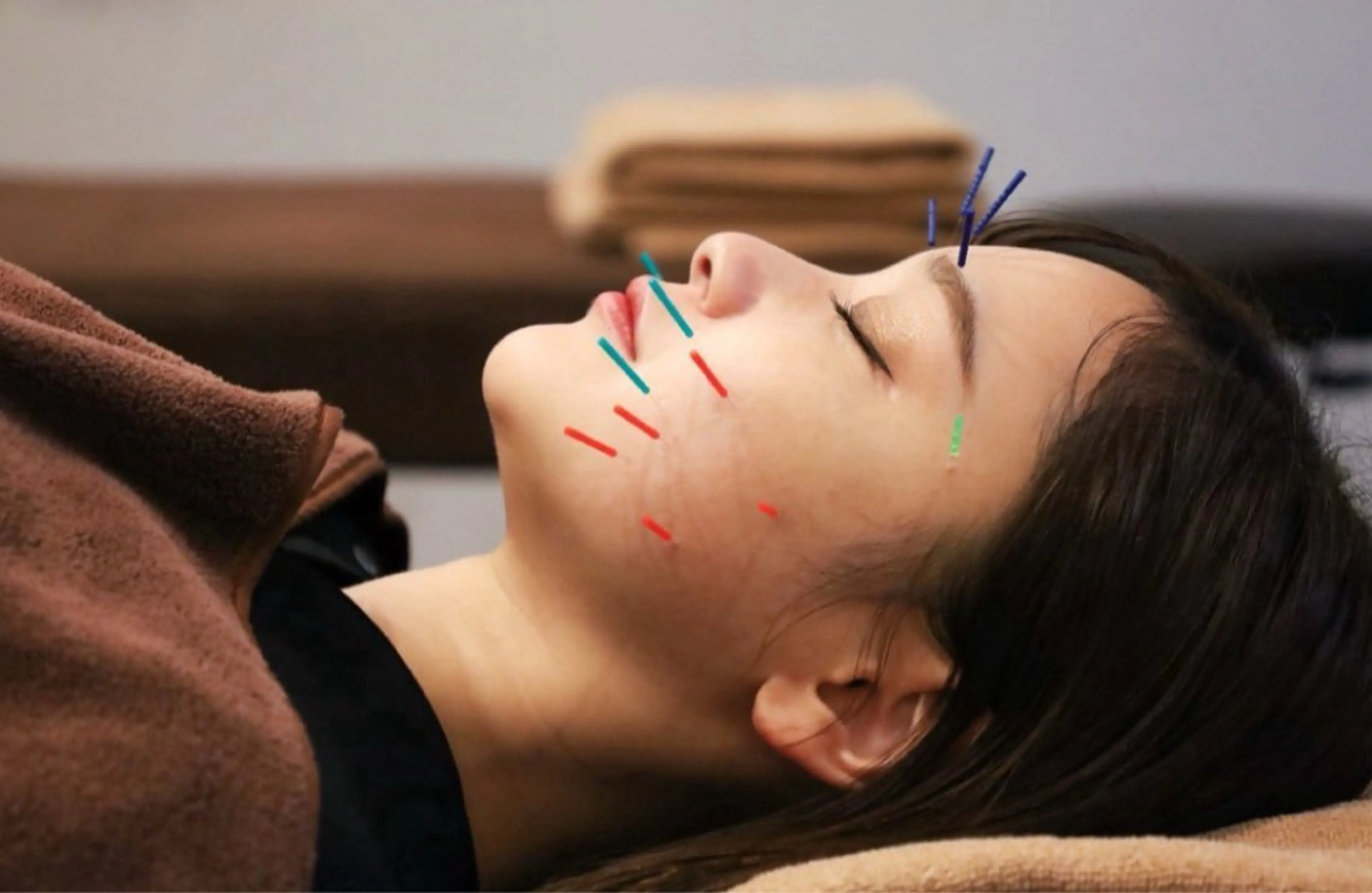 【美容鍼✨】むくみ撃退！小顔スイッチON💆‍♀️の写真