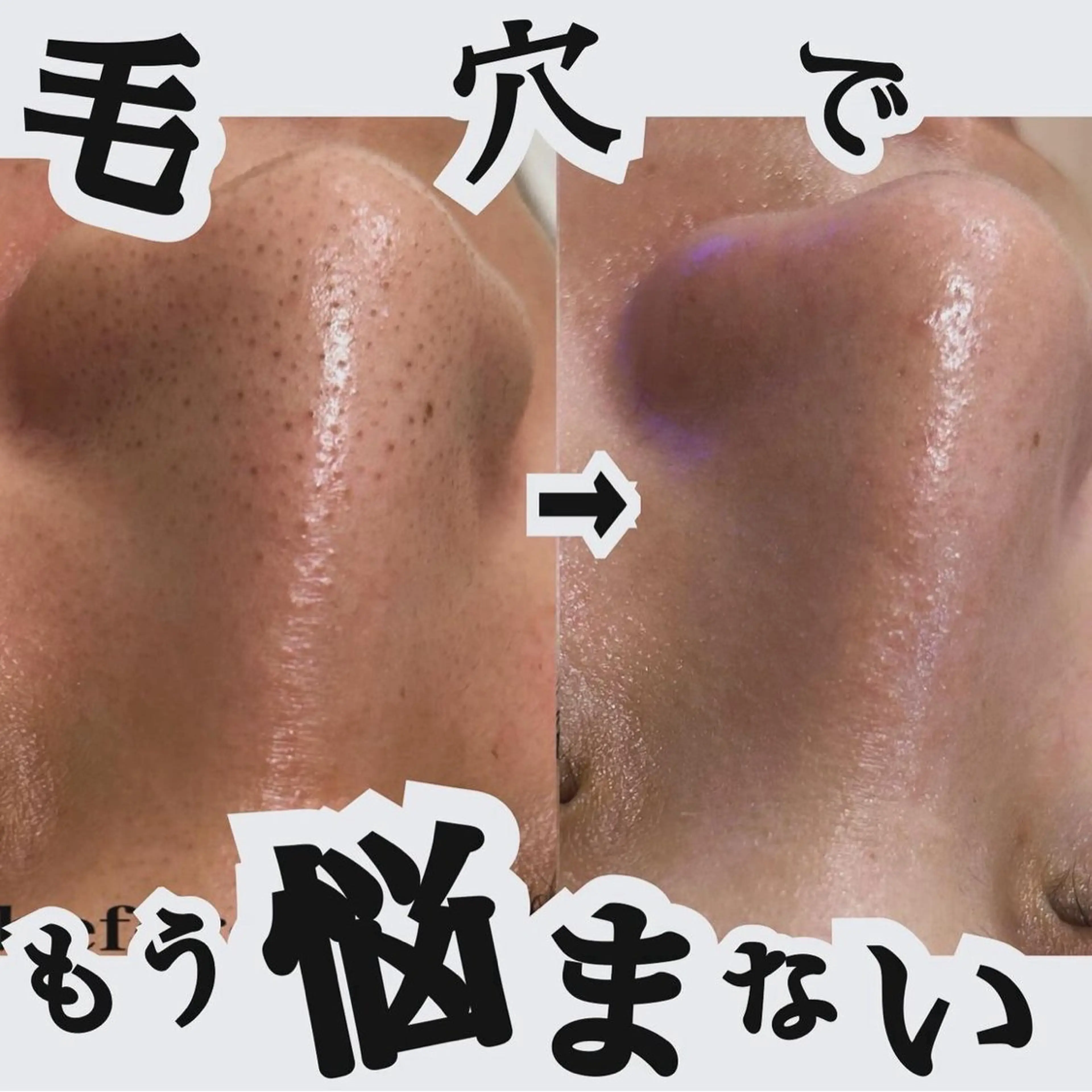 毛穴吸引💆‍♀️✨お試しコースの写真