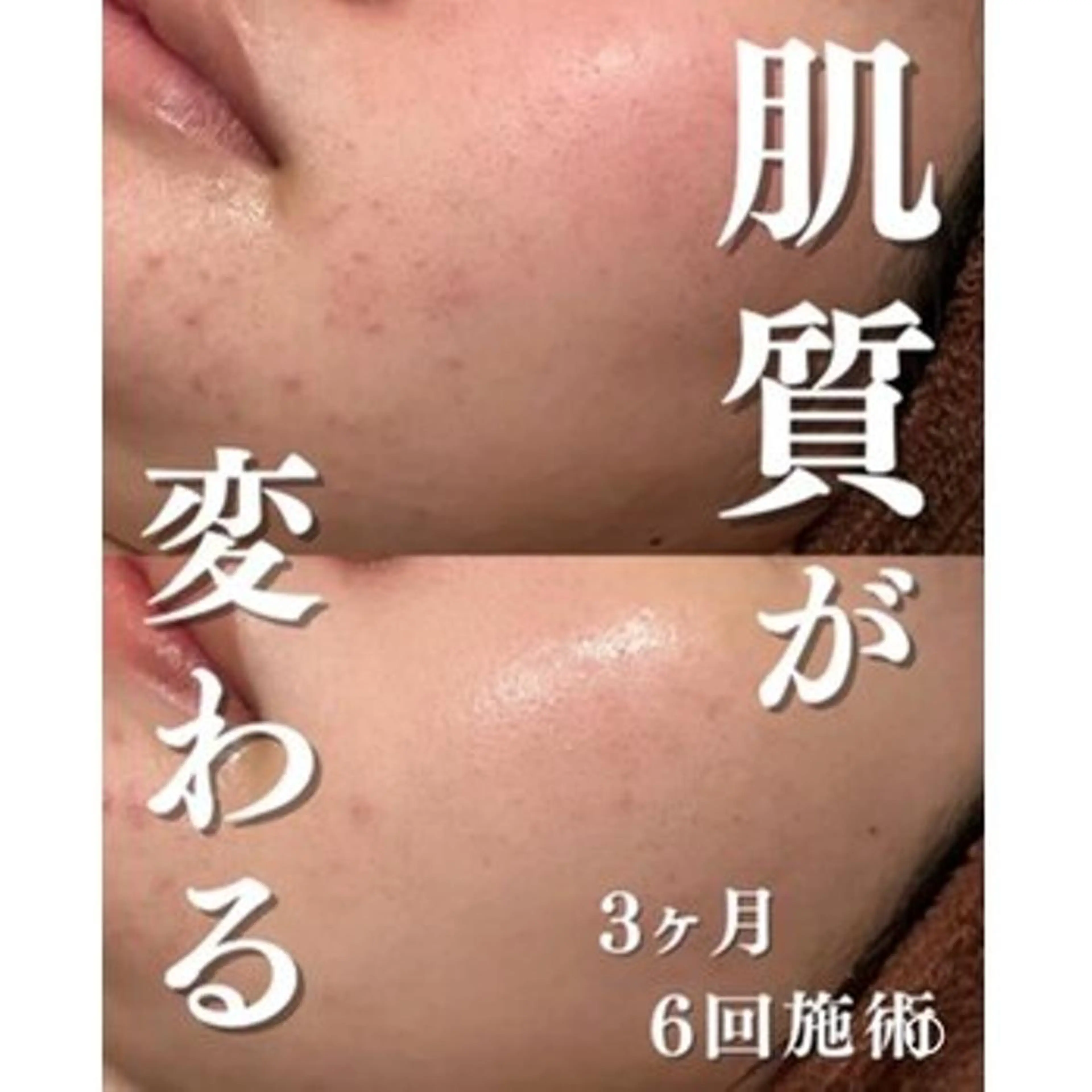 3か月で肌革命👼 ニキビ専門店💫のエステ・リラクイメージ