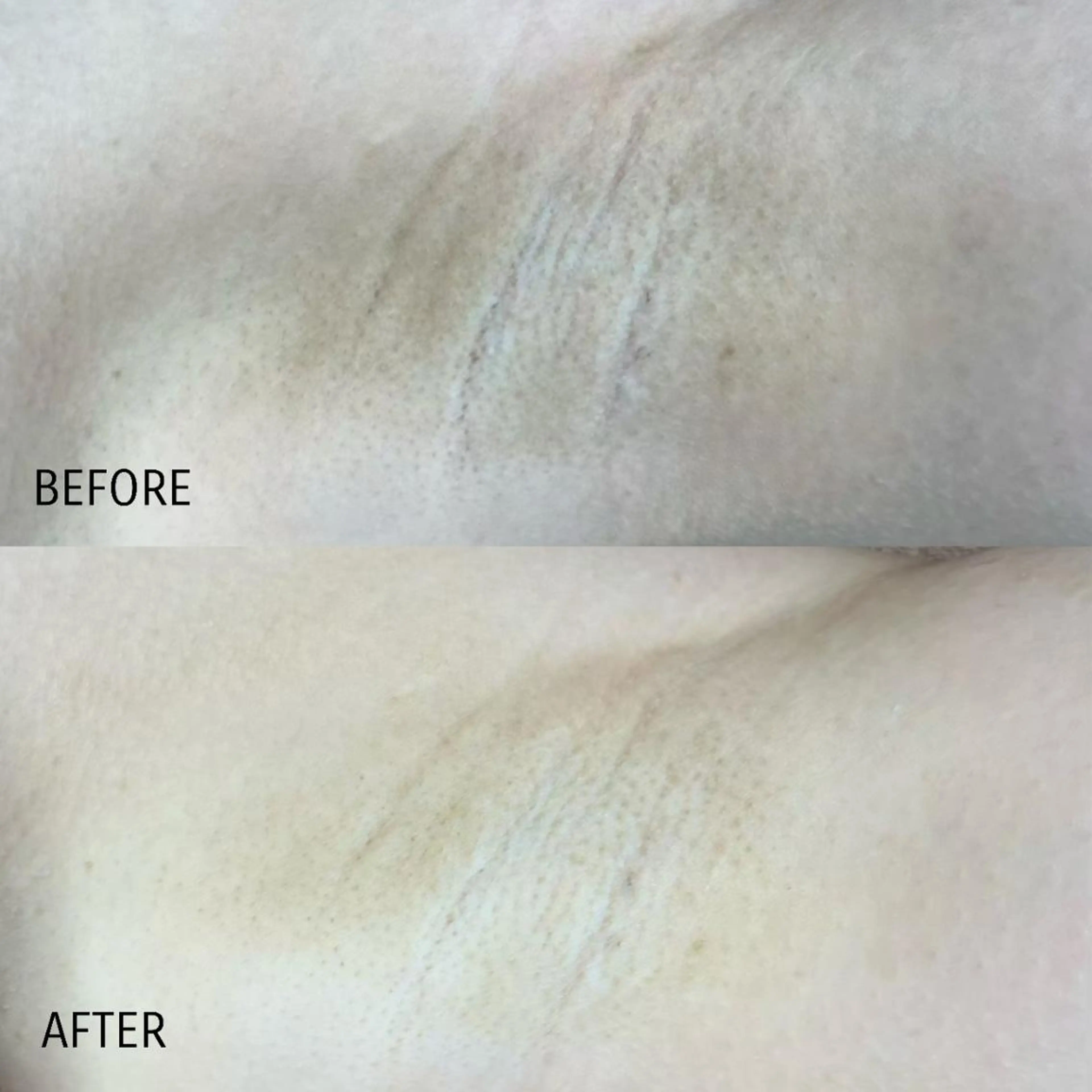 脇の黒ずみ ララピール 8800円➡の写真