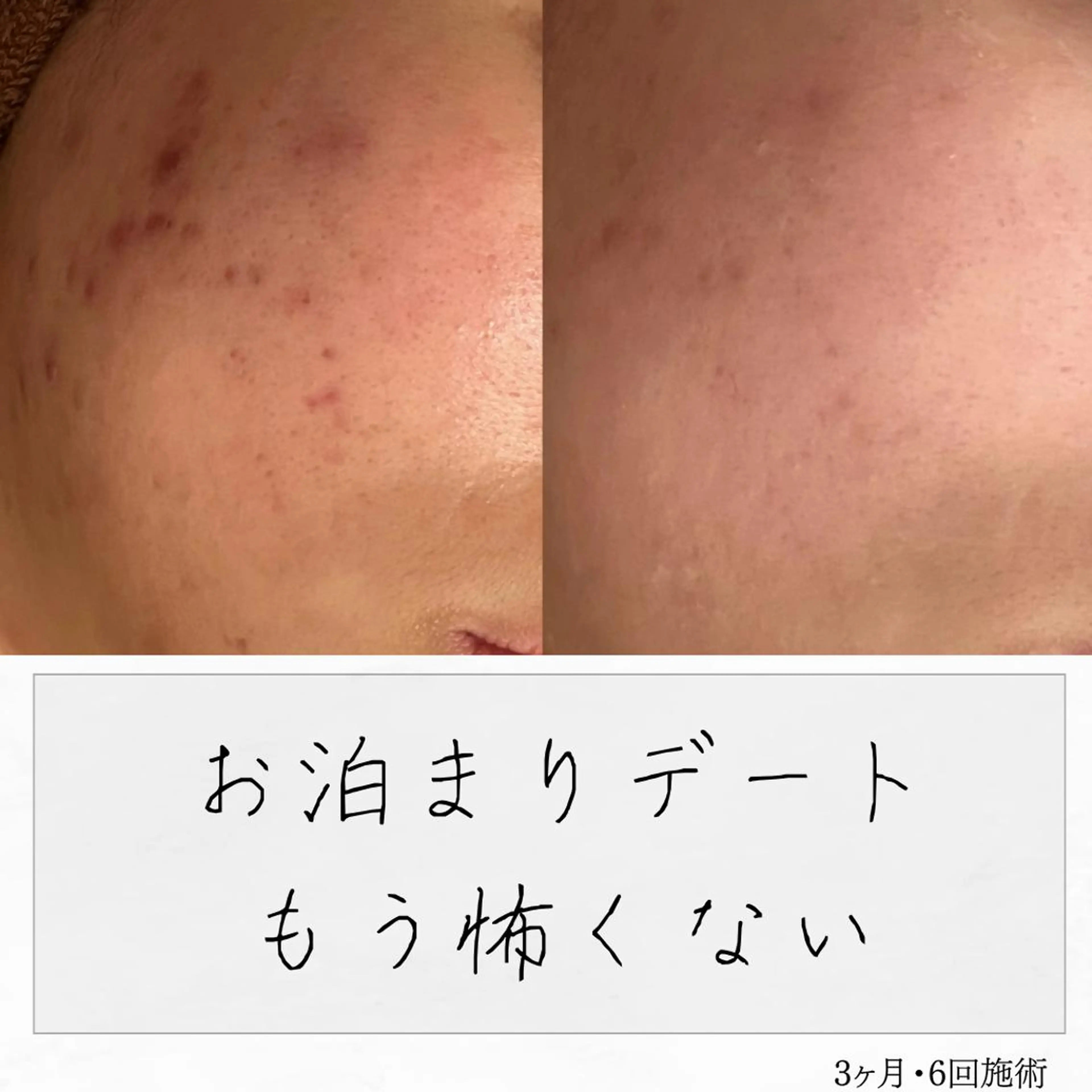 ニキビ経験者が施術 する専門サロン🌻のエステ・リラクイメージ