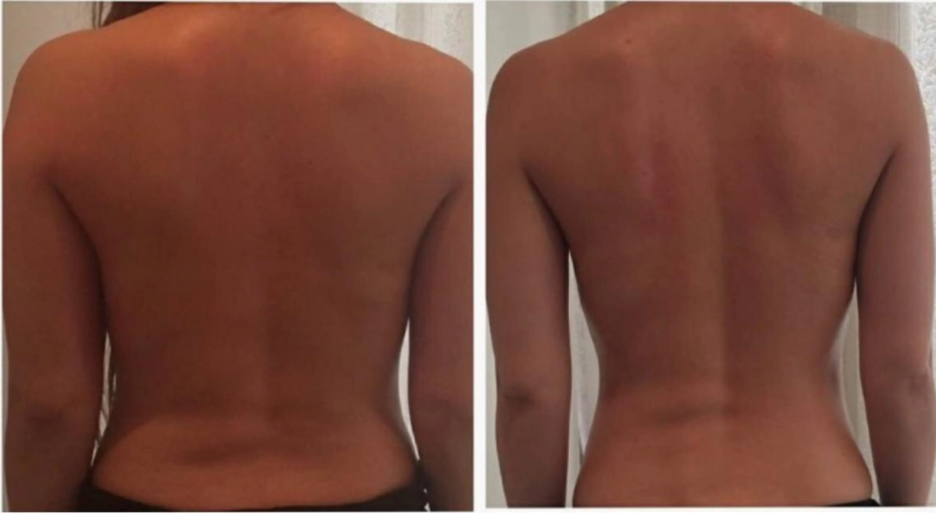 【薄着になる前に肩こり卒業】分厚い背中、春服映える60分｜痩身エステの写真