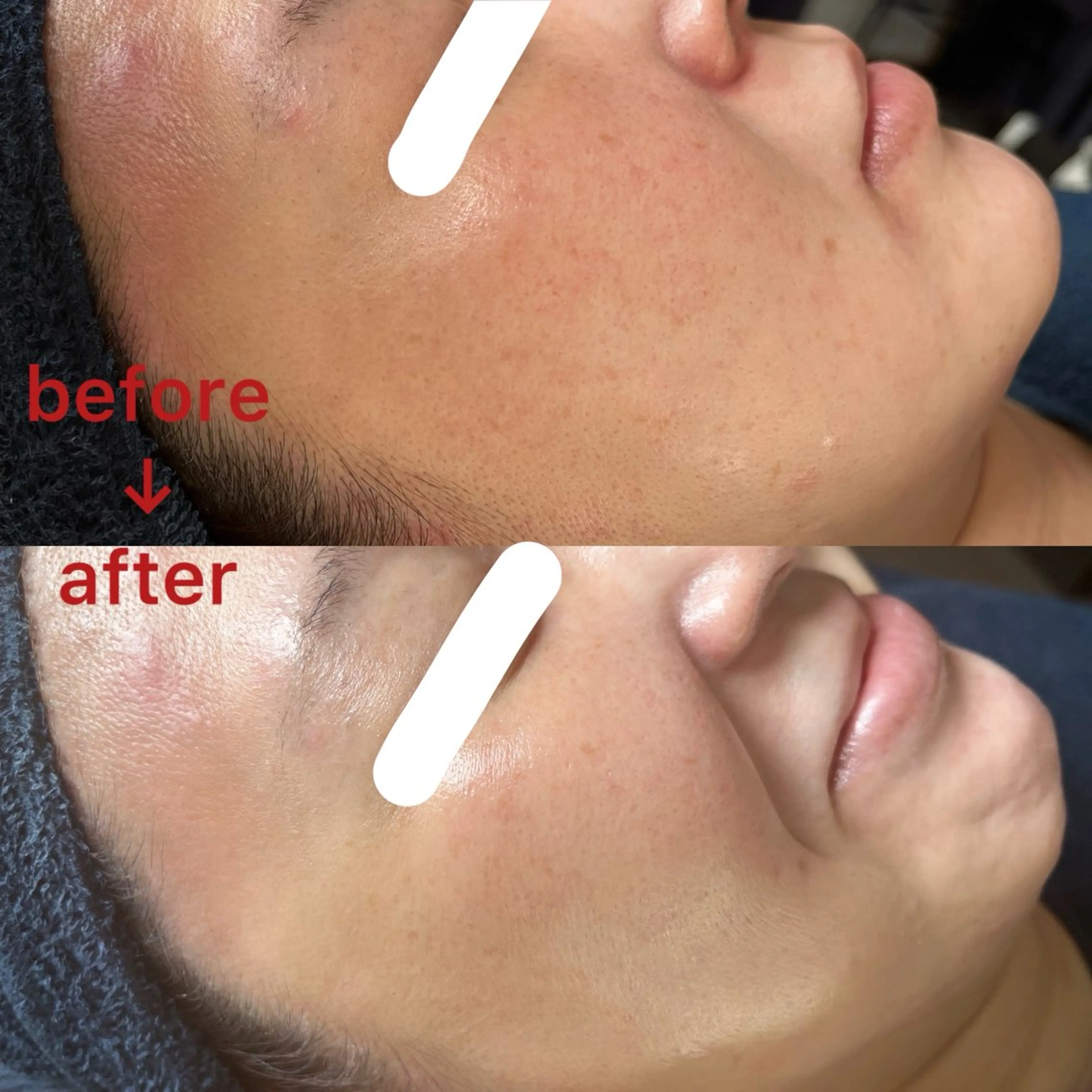 今からでも大丈夫！夏の紫外線ケアフェイシャル80分（夏に浴びた紫外線にお悩みの方はこちら）の写真