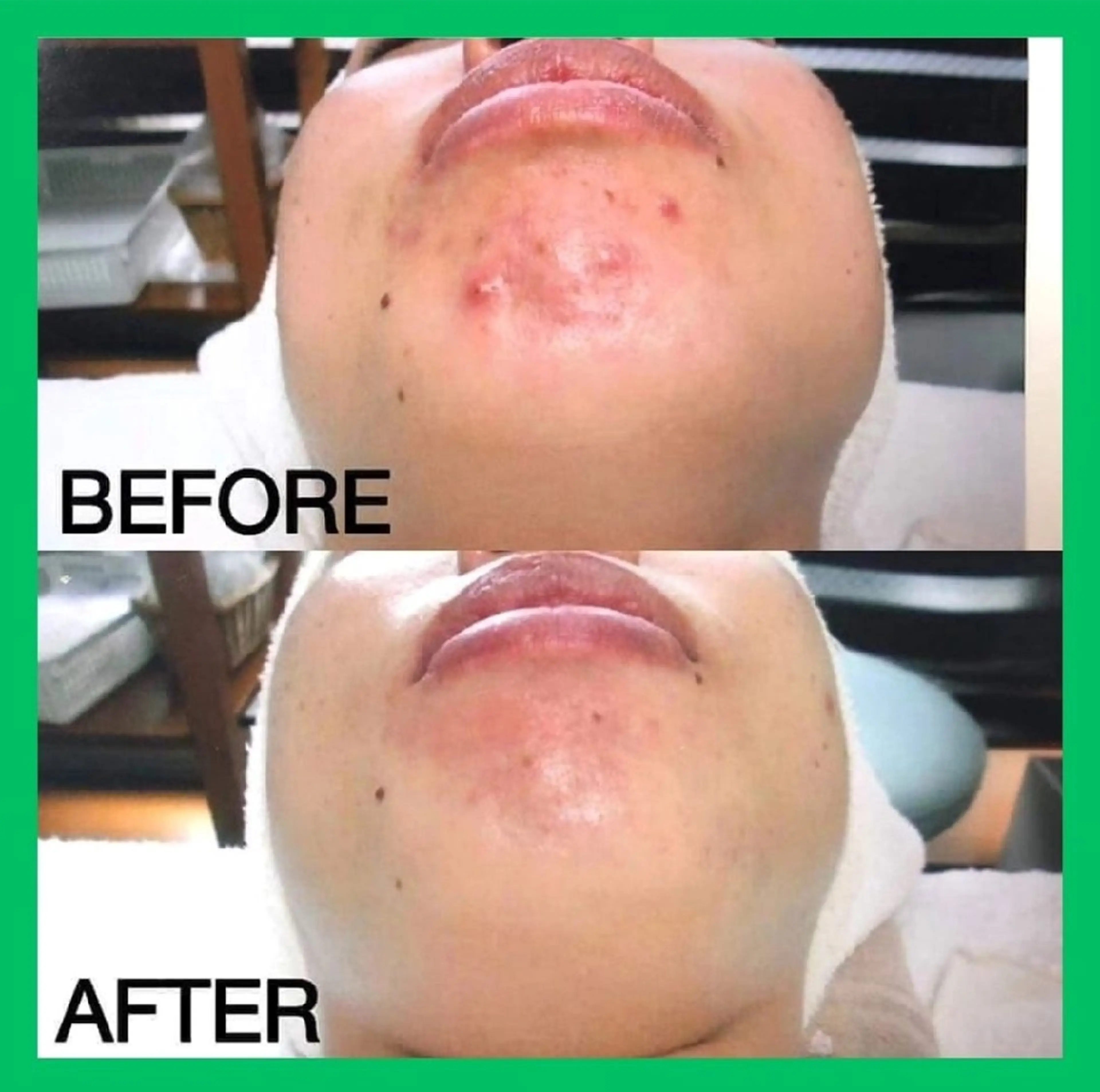 《人気NO.1》【平日限定🈹】《ニキビ・ニキビ跡》ニキビケア2回体験🌄(19歳以下不可)　[大阪城北詰駅/京橋駅]の写真