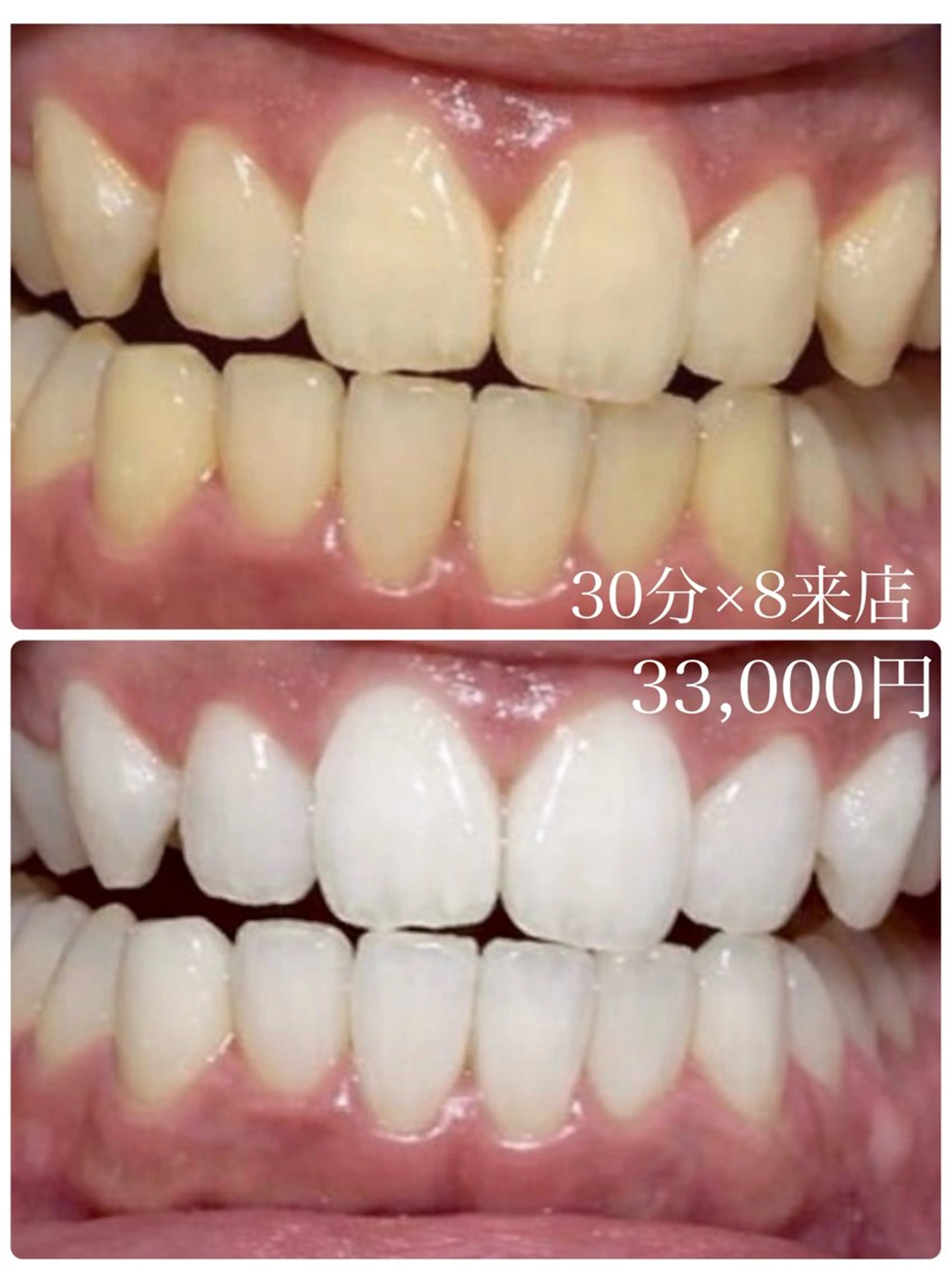 エステ プラチナムビューティー柏所属・【歯科提携】柏ホワイ トニングスタイルのその他イメージ