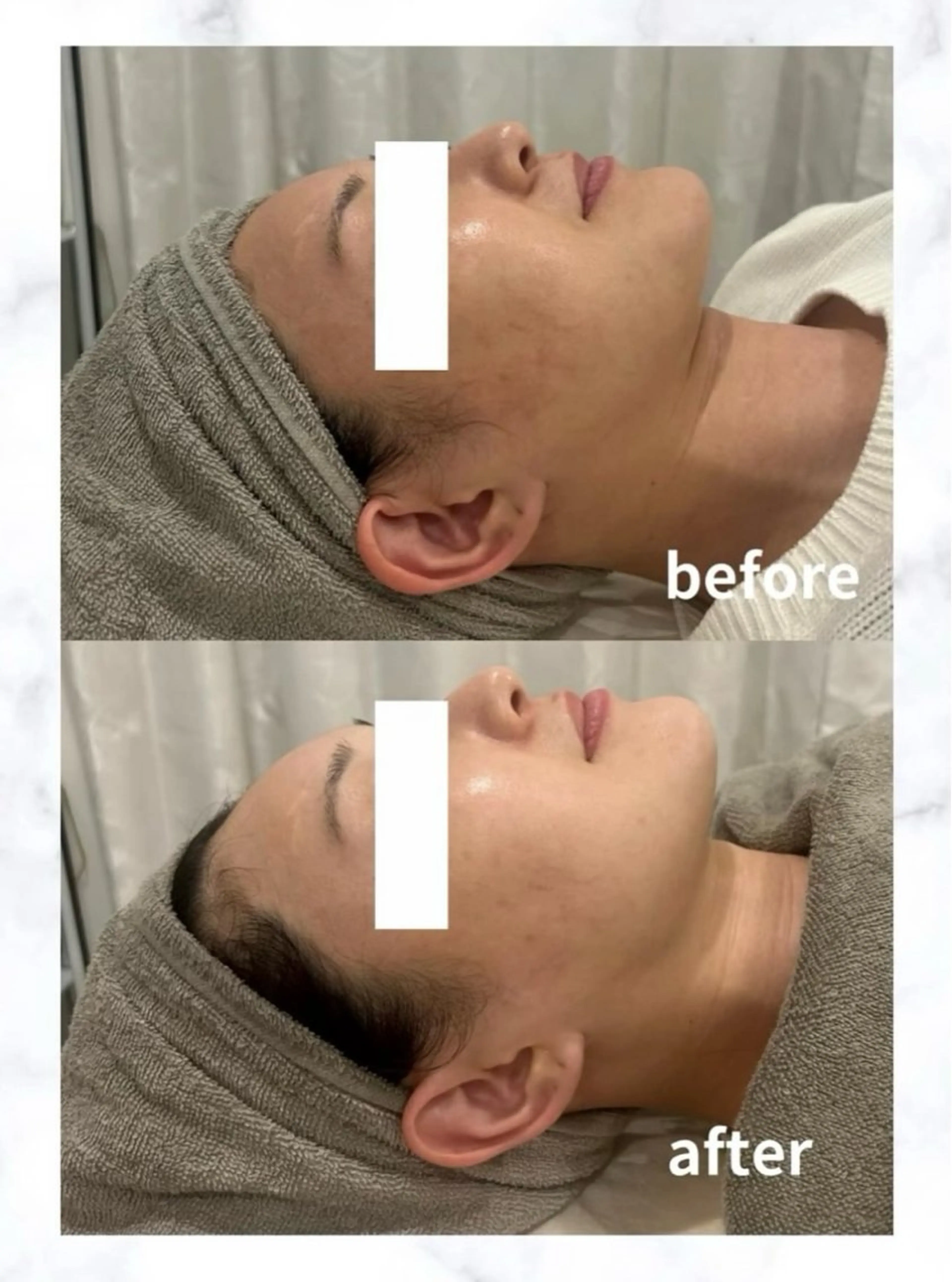 ⭐︎美白メニュー【乾燥やくすみが気になる方へ】最新の韓国プラピールで驚く程の美白ツヤ肌！16,000円→12800円の写真