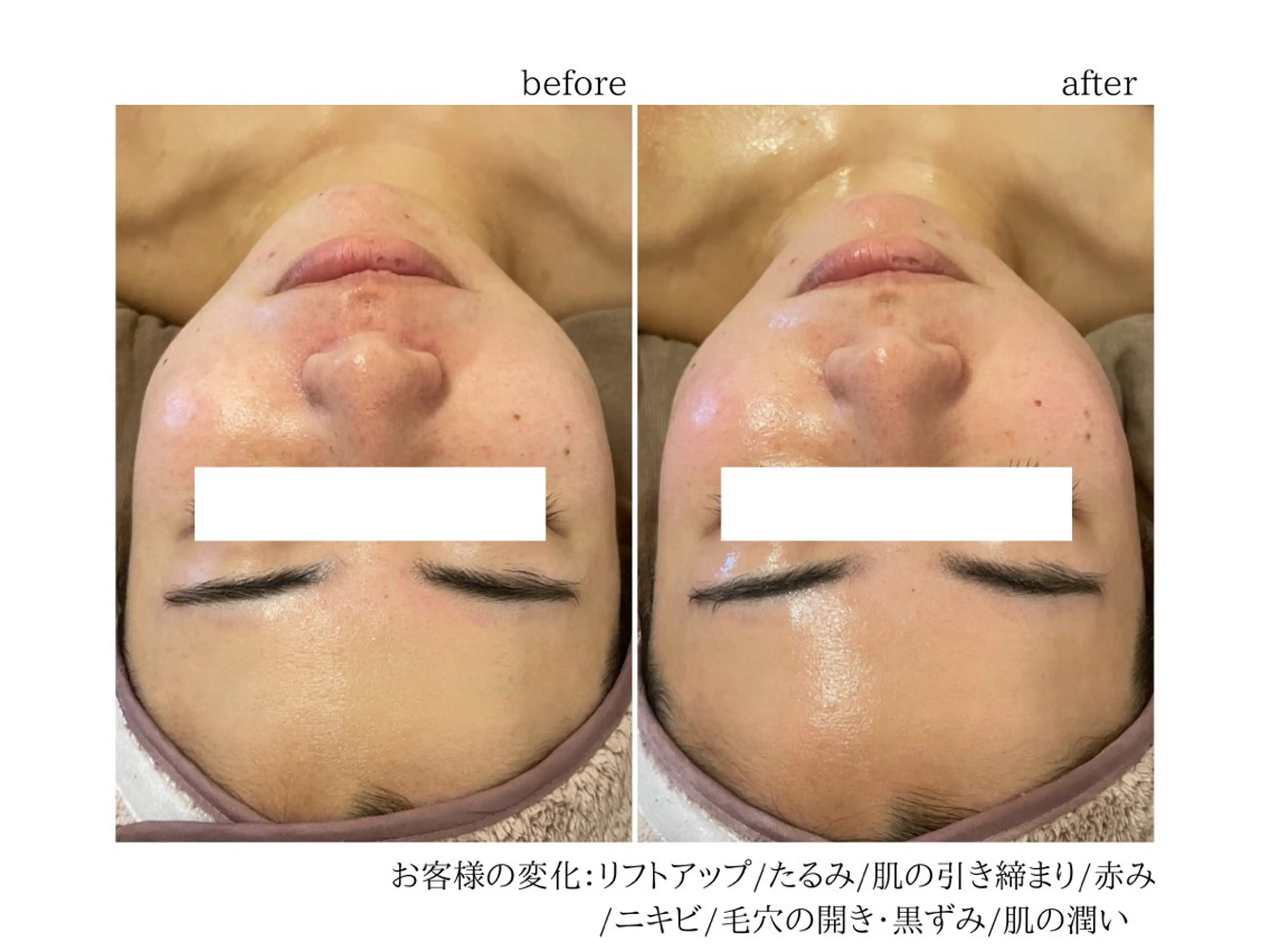 【プレミアム×2回】結果出し！たるみ改善/リフトアップの写真