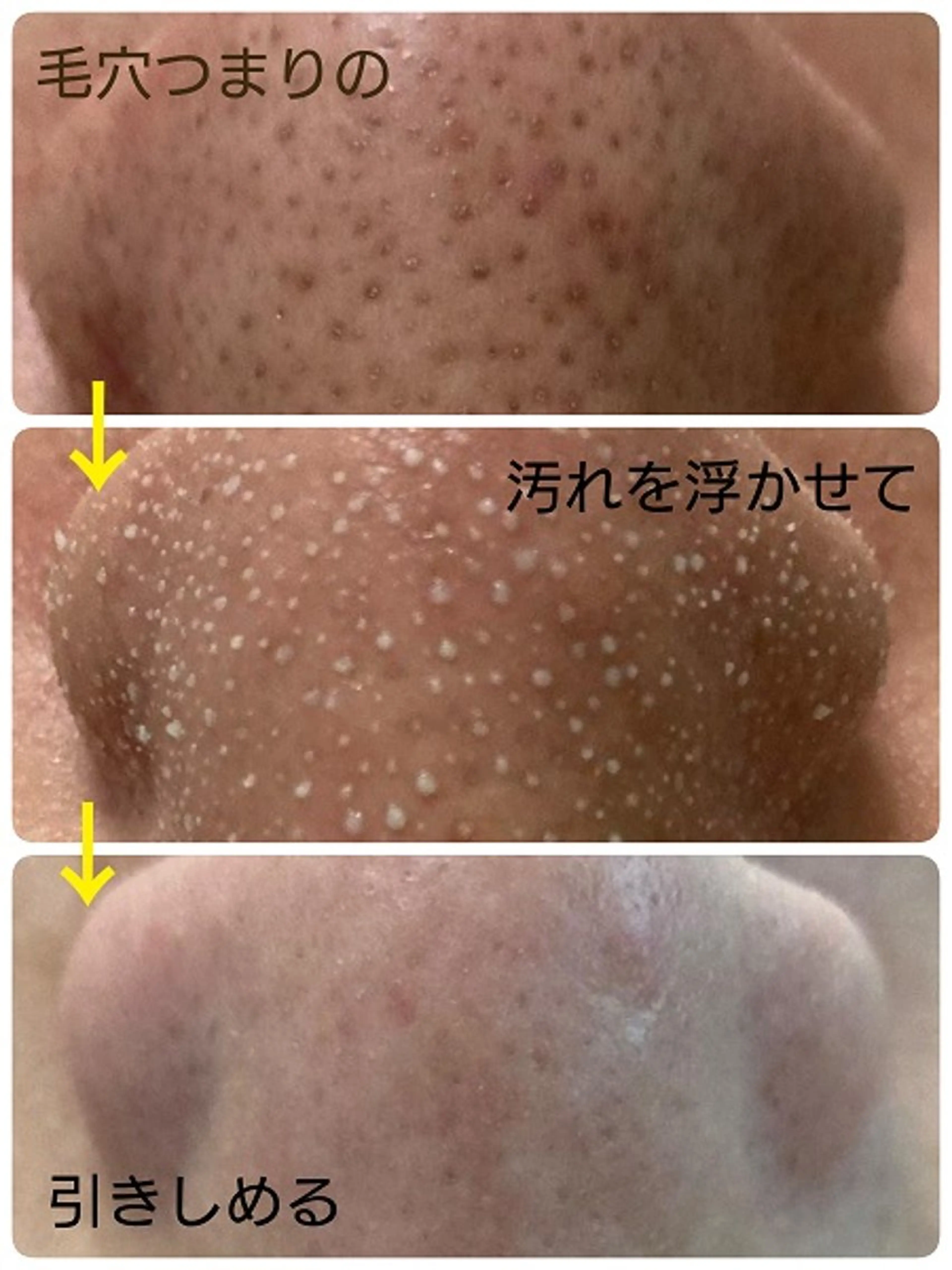 【話題沸騰！ニキビ•皮脂•テカリ】ハイパワー毛穴洗浄　全顔の写真