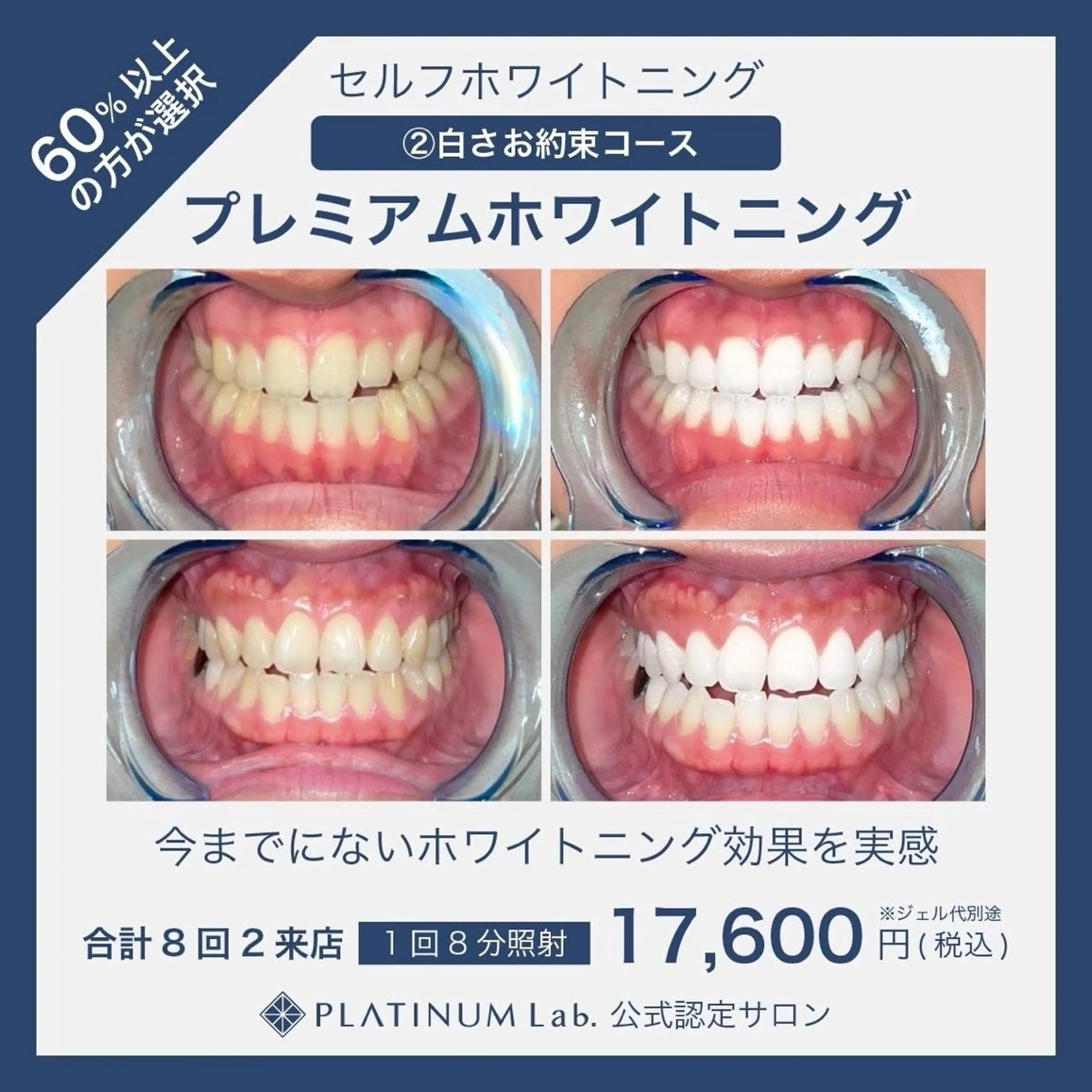 【本気で白くしたい方】プレミアムセルフホワイトニング40分×2来店 合計80分🦷✨の写真