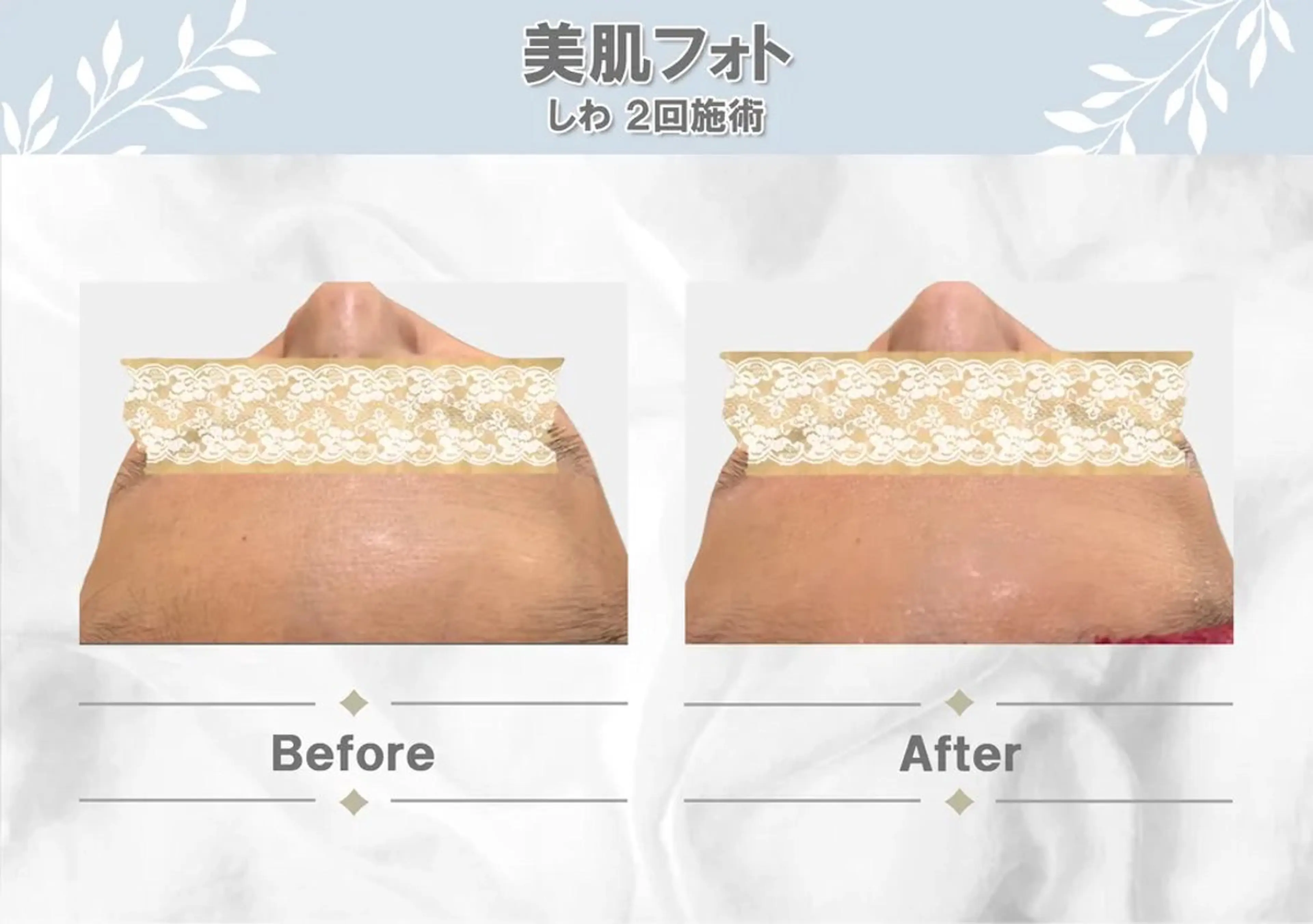 ✨美肌フォト✨おでこ💎の写真