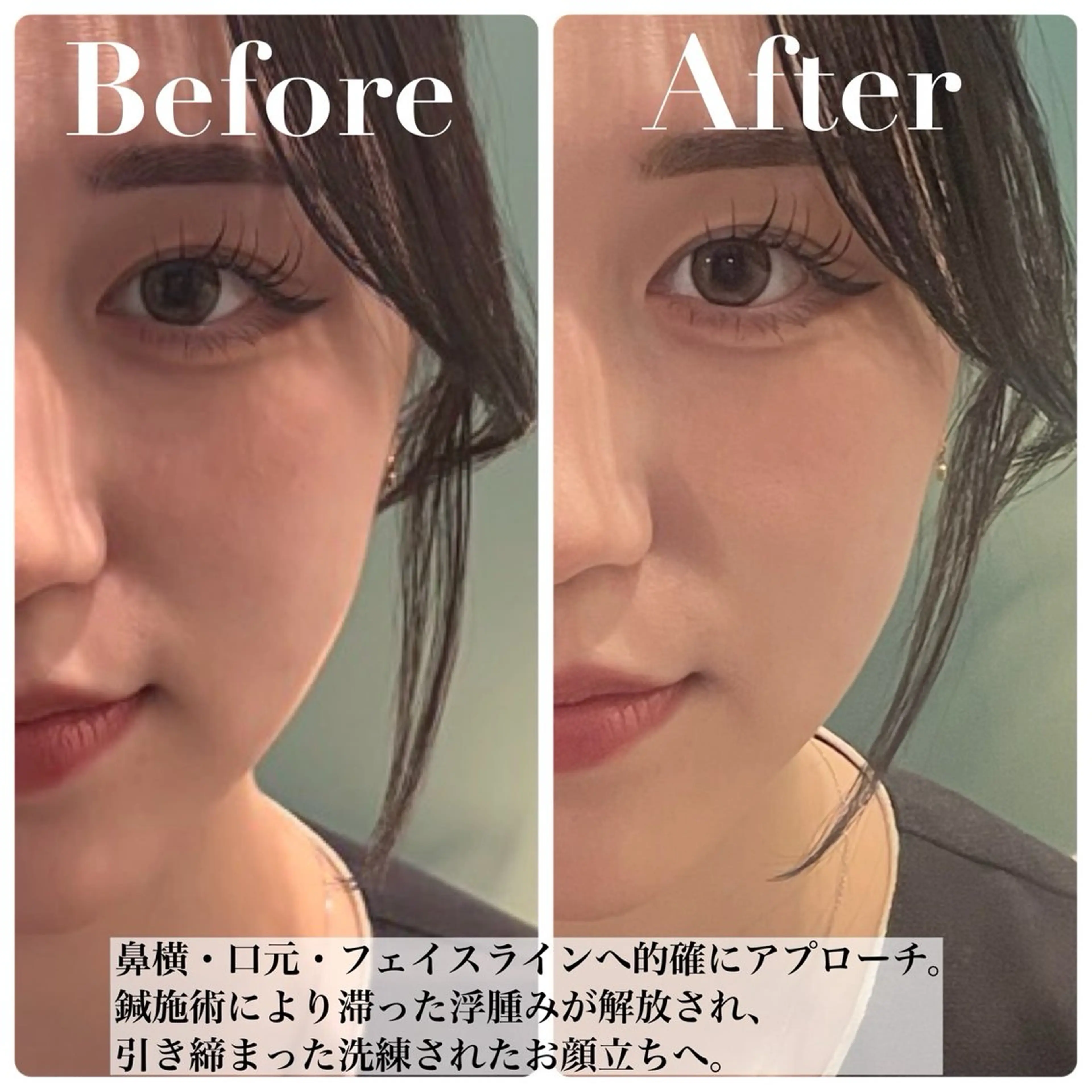 エステ nano.face名古屋駅前店所属・美容鍼/小顔&整体 nano.faceのエステ・リラクイメージ