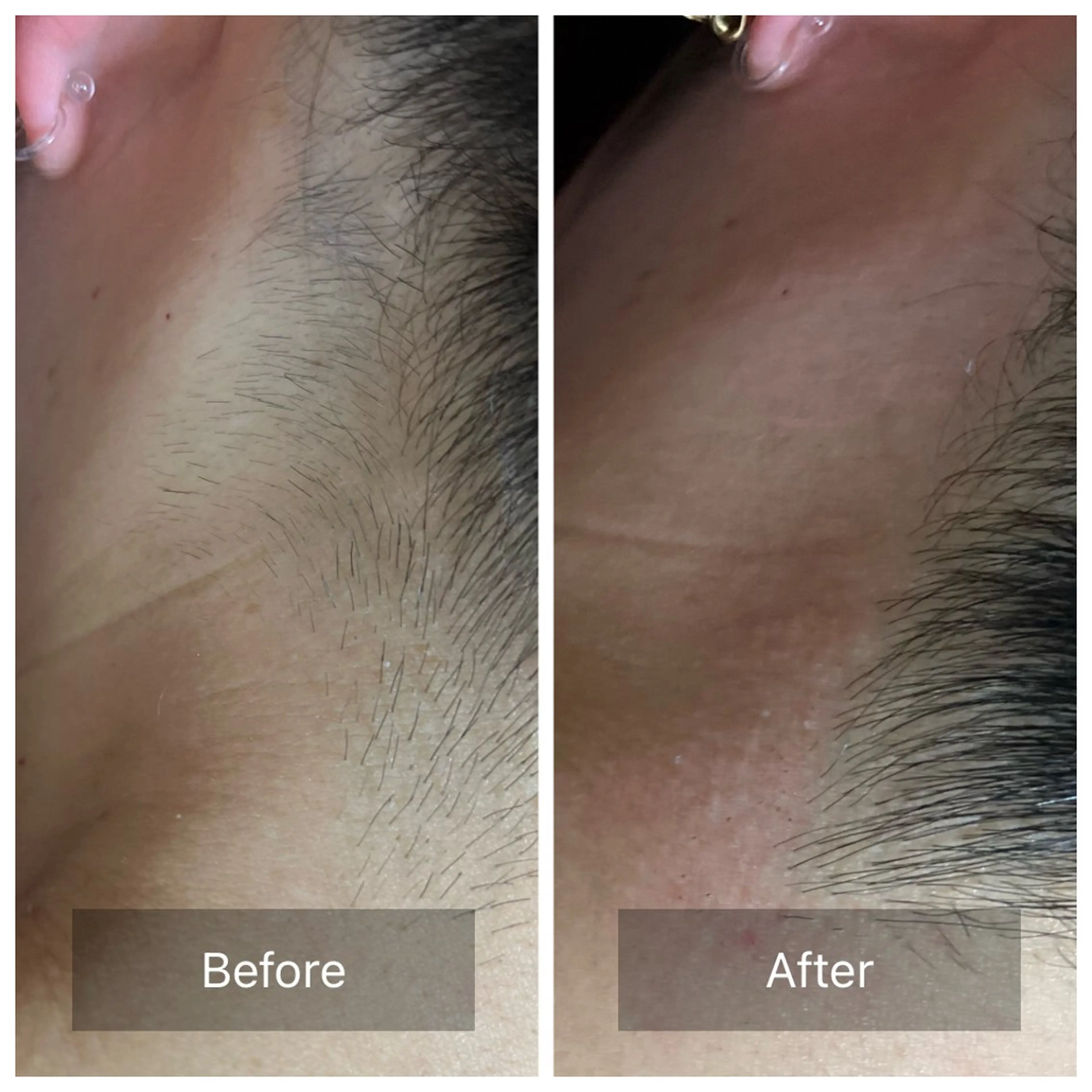 脱毛 Salon Improveのネイルデザイン