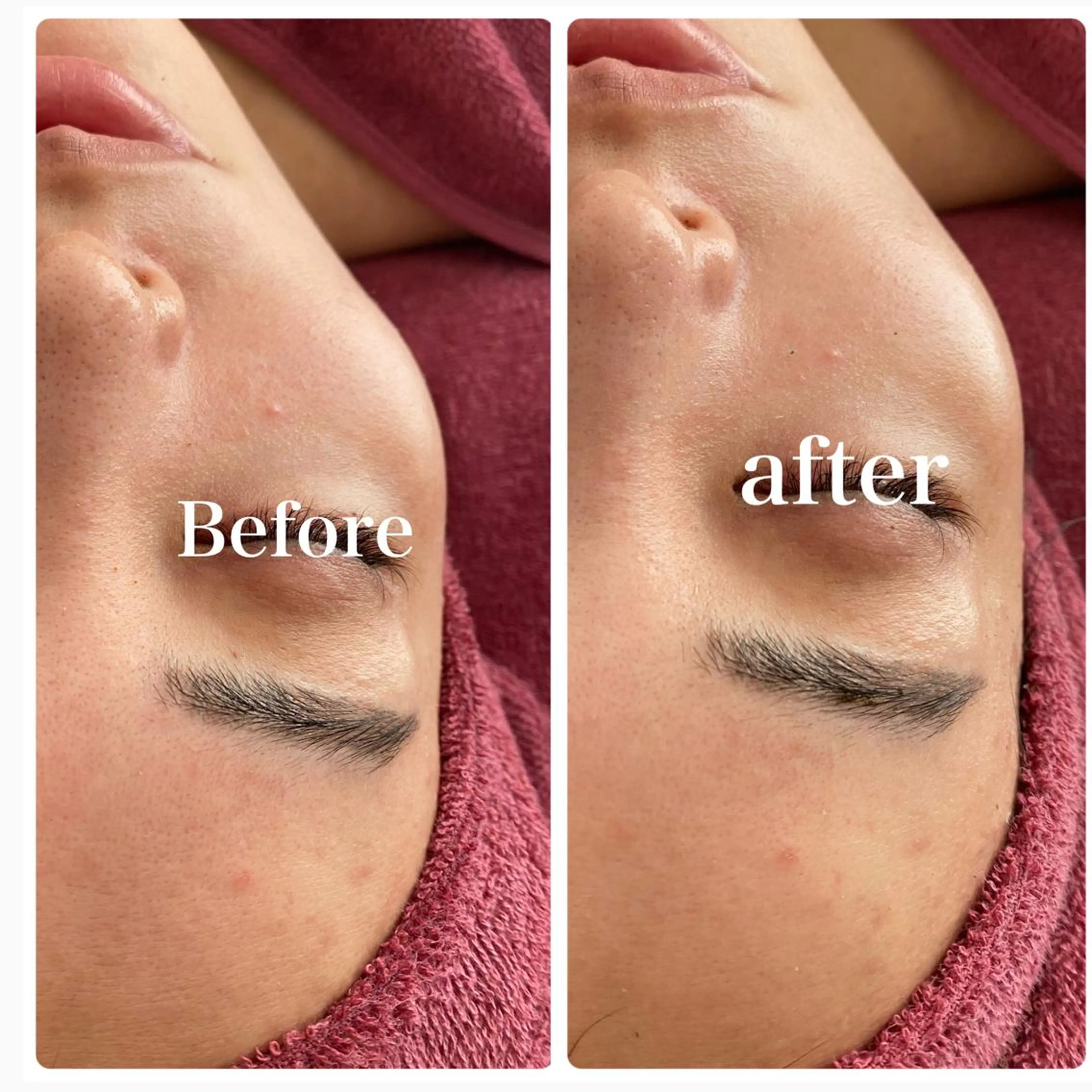 エステ REVI取扱・肌悩み 毛穴Chalonのエステ・リラクイメージ