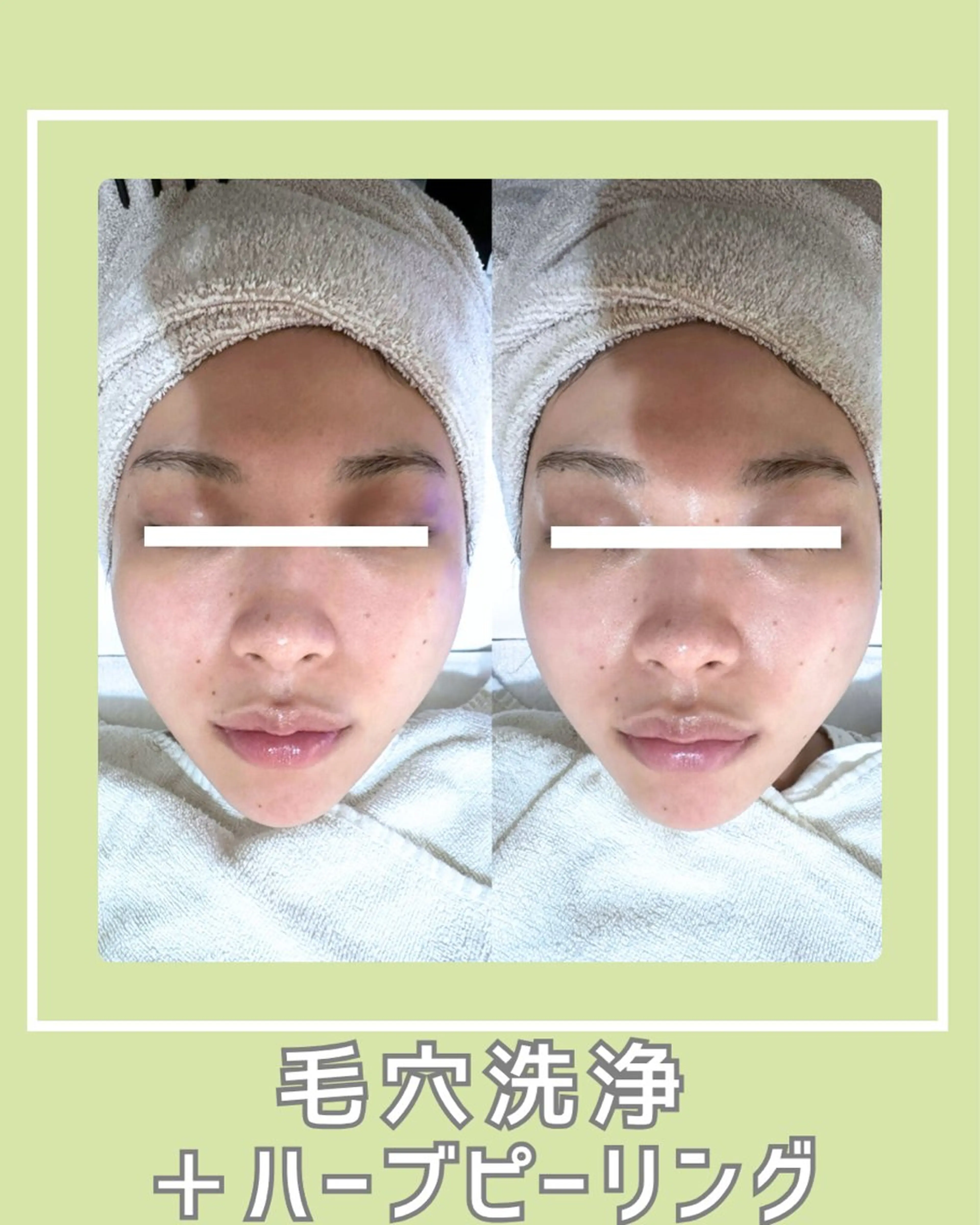 |ピーリング・毛穴| soina神楽坂のエステ・リラクイメージ