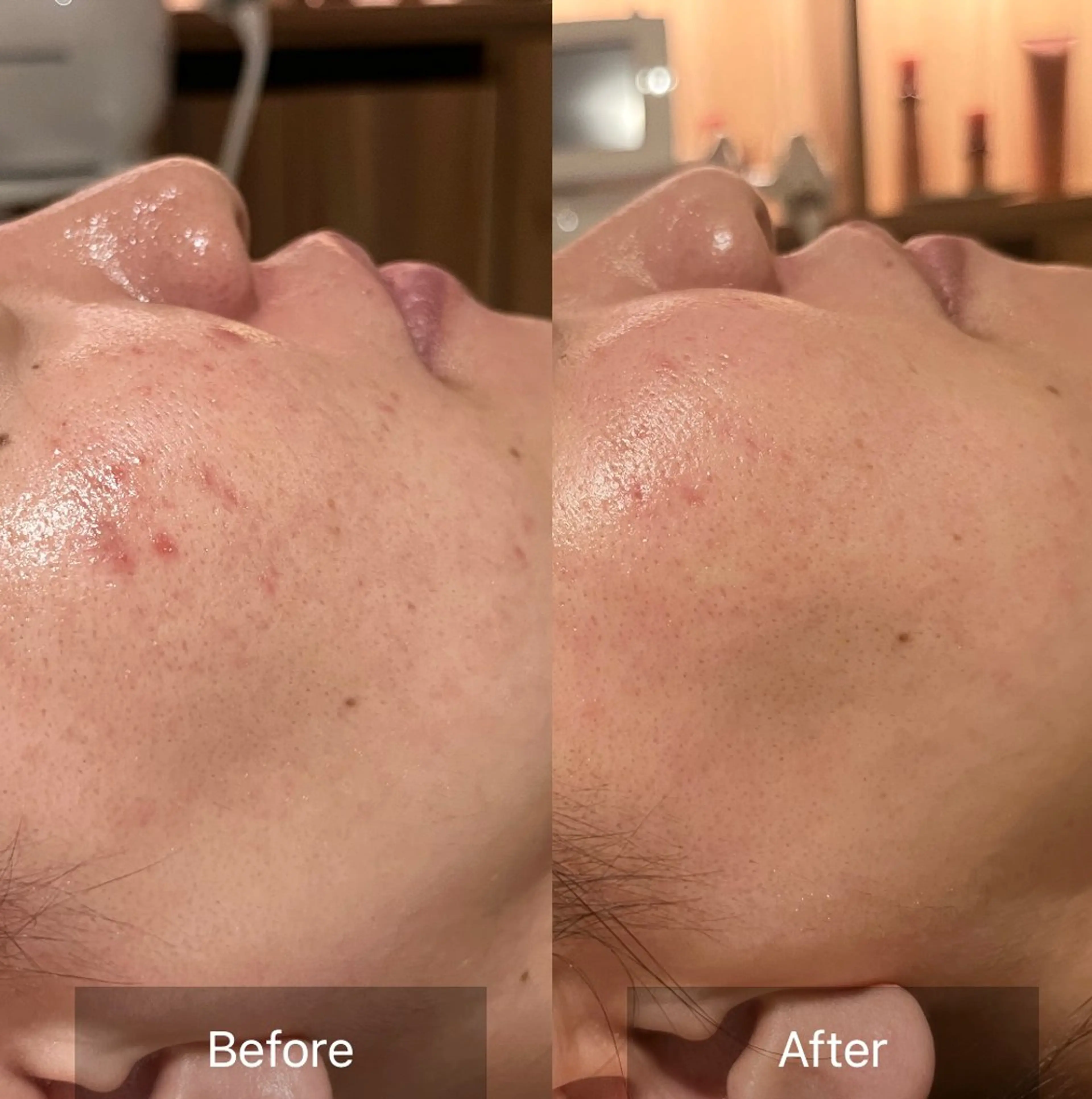 【🔥4/9.10.12.14限定🔥ピーリング初めての方におすすめ】ピーリングや毛穴ケアが限定価格で体験🌿の写真