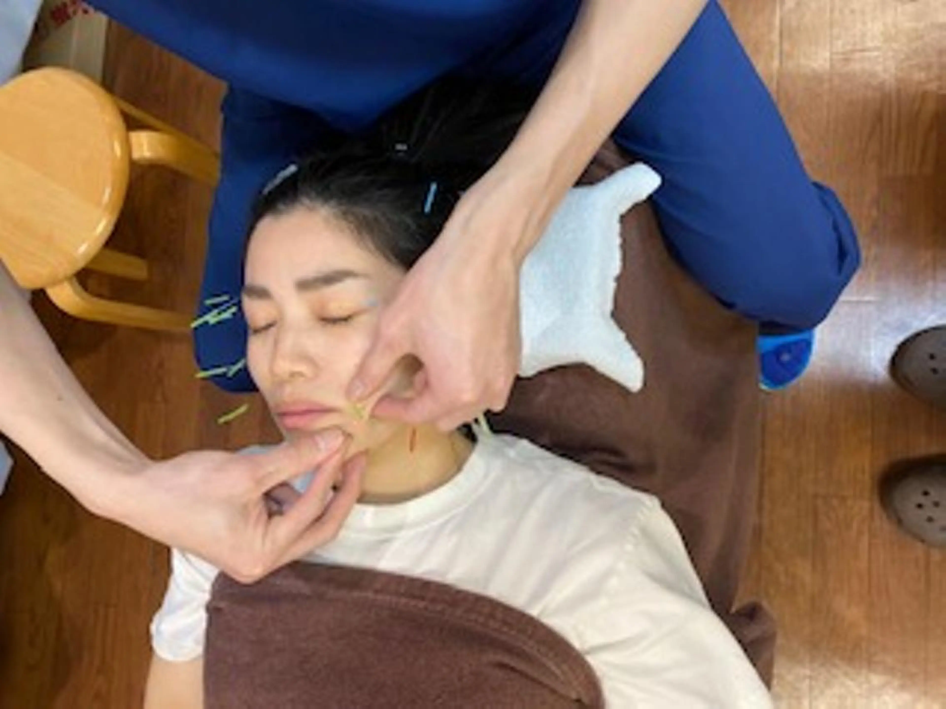 フェイシャル+美容鍼 (所要時間60~80分かかる場合があります。)の写真