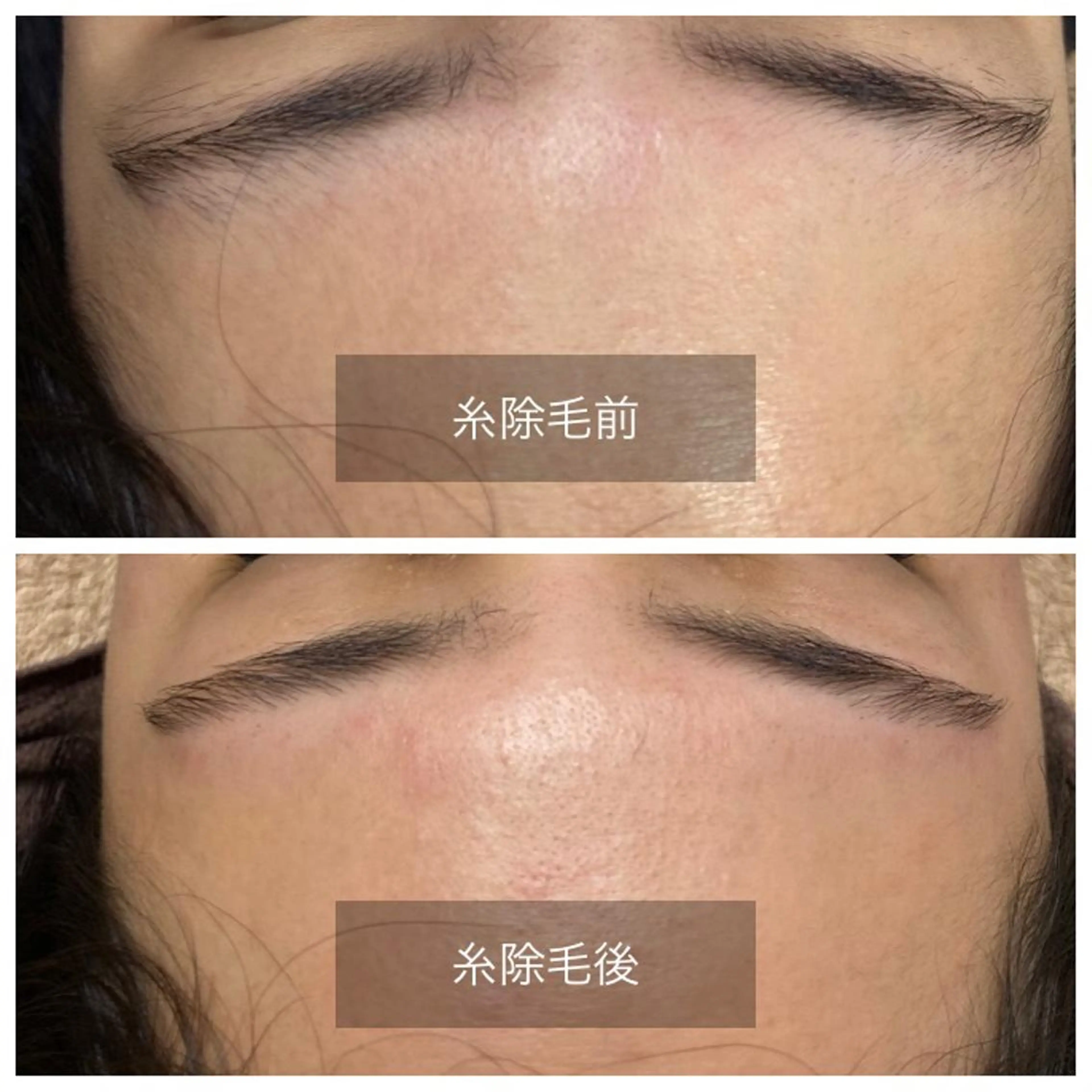 おでこ糸脱毛　糸一本のみの写真