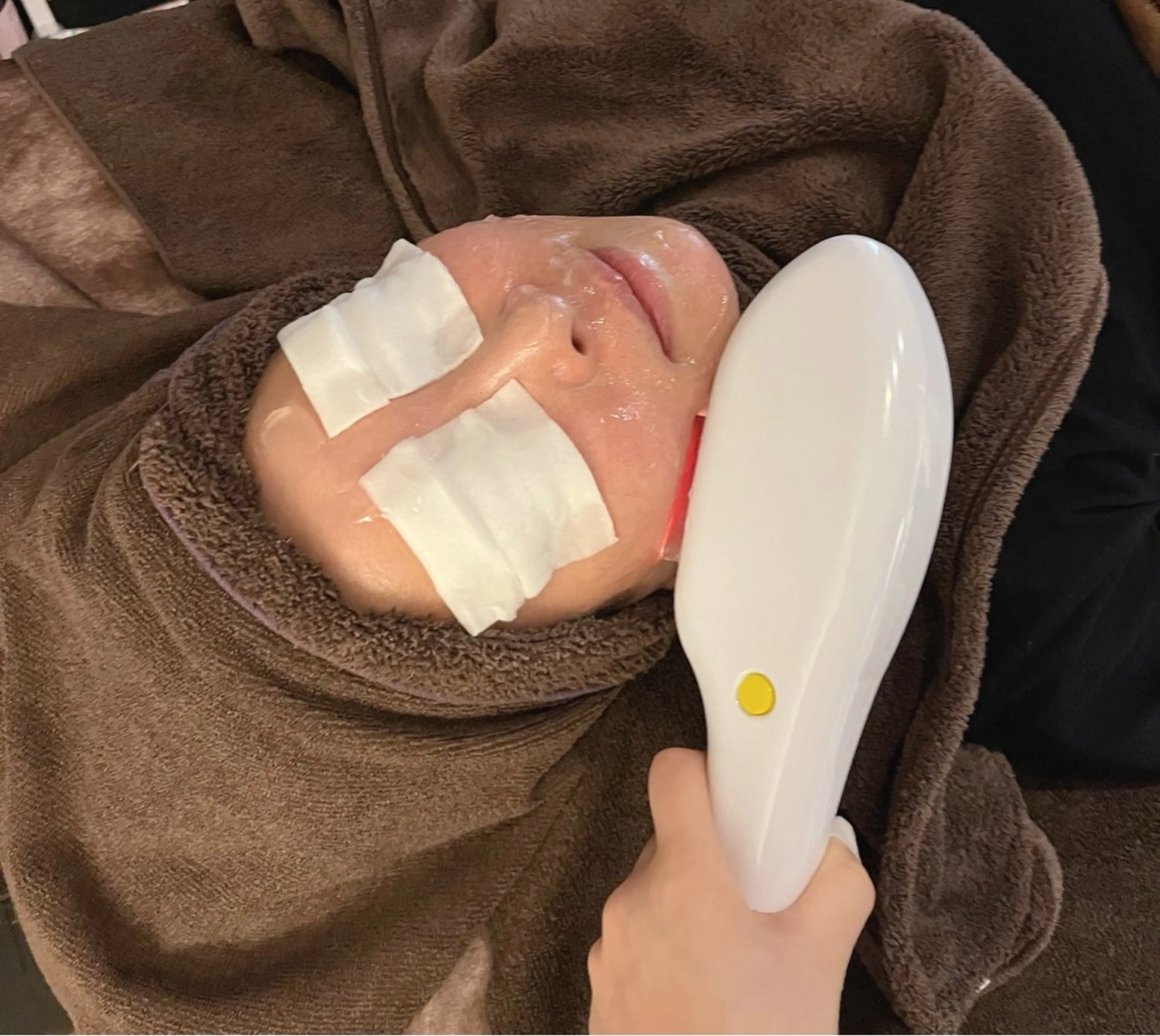 🎓ミニモ学割U24|お顔光脱毛(毛穴ケア付き) ¥3,980の写真