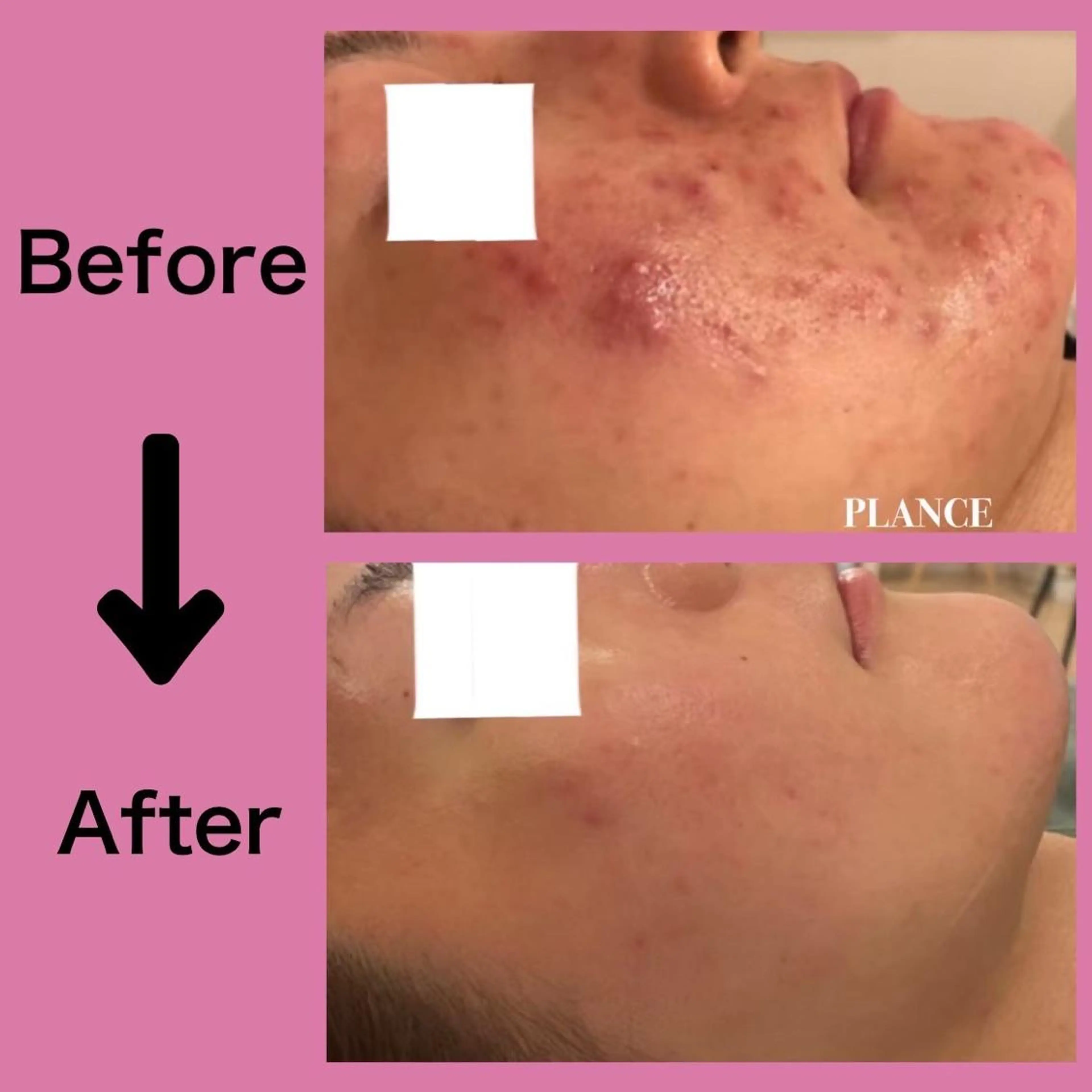 エステ フェイシャル専門 肌質改善/プランスのエステ・リラクイメージ