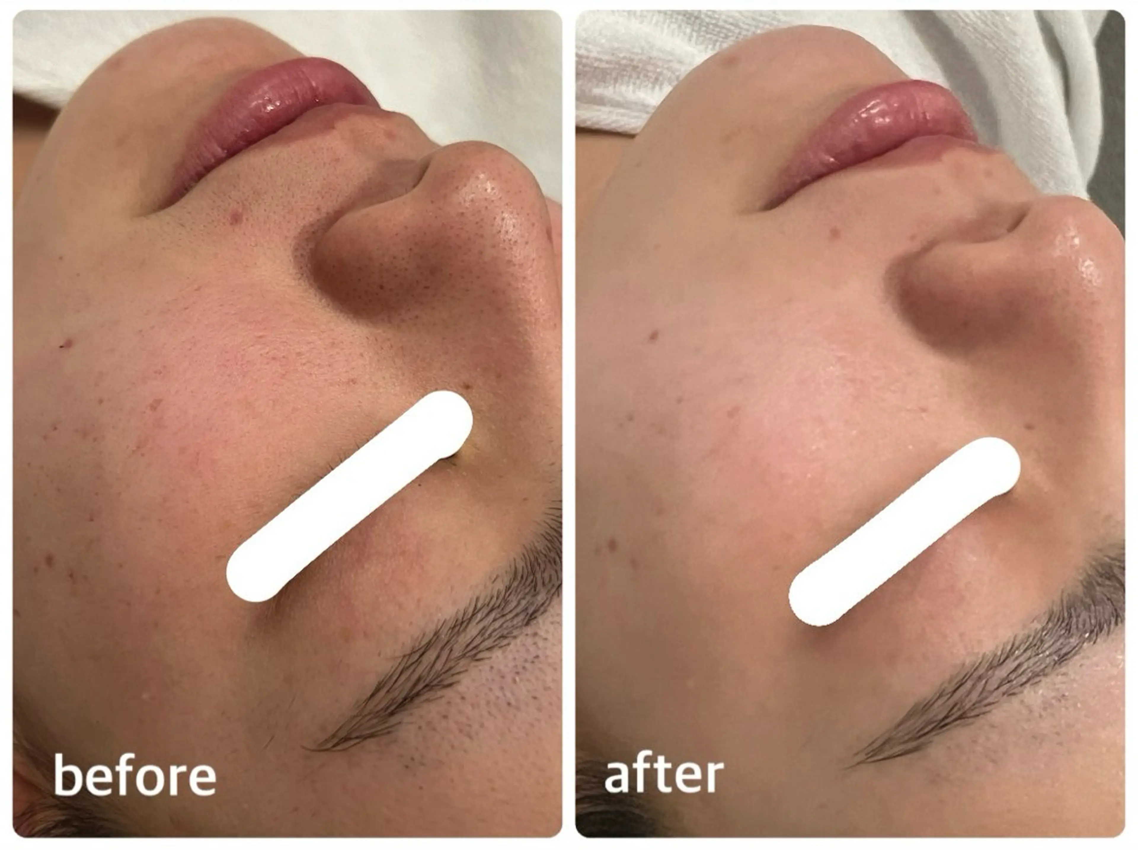 【ご新規様特別価格】肌質改善/リラックス🫧フェイシャルマッサージトリートメントの写真