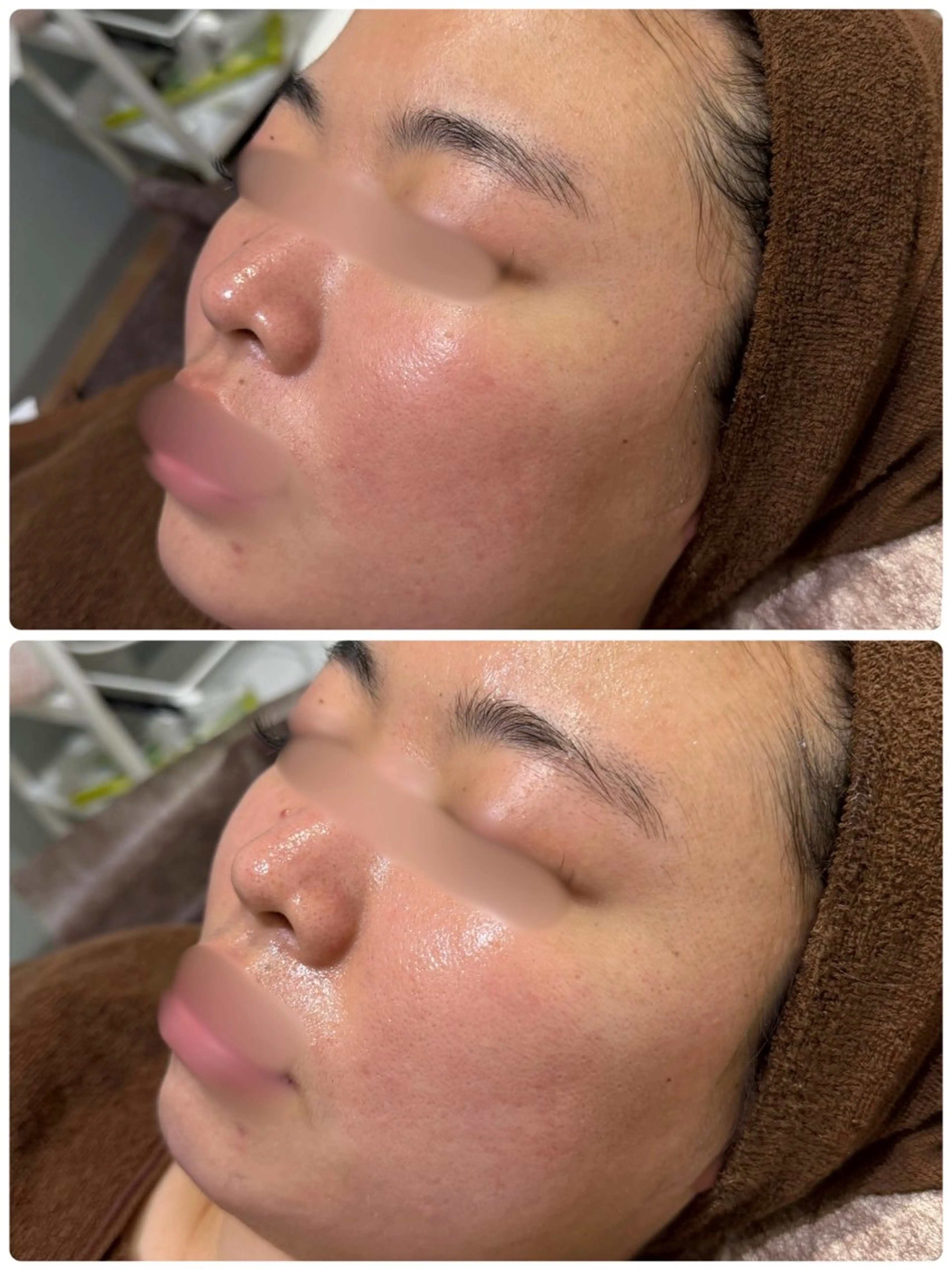 毛穴改善ハーブピーリングMinouミヌ心斎橋所属・今西 彩夢 Minou心斎橋店のエステ・リラクイメージ