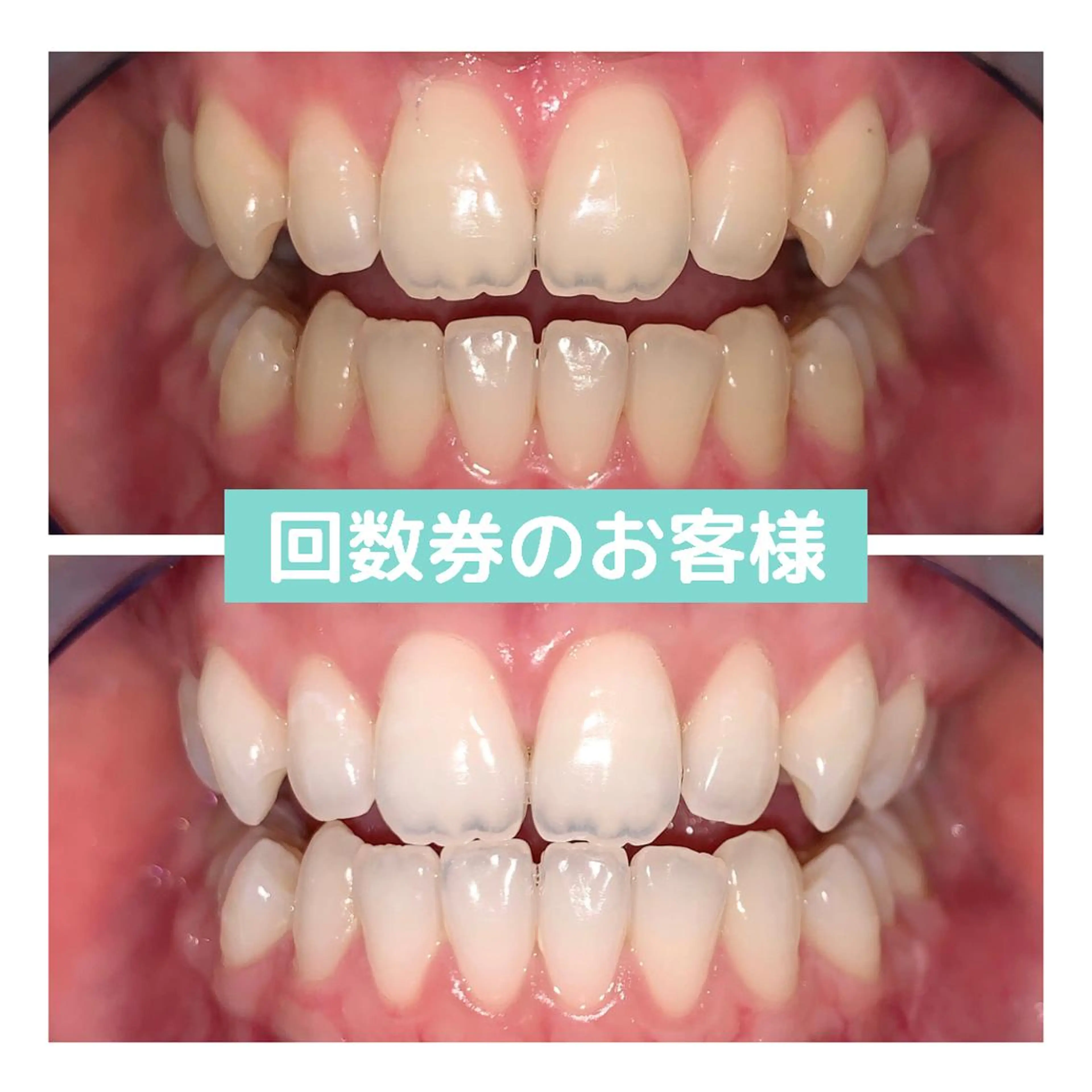 ホワイトニング｜韓国式3D毛穴洗浄 lonhana ﾛﾝﾊﾅ所属・韓国式3D毛穴洗浄 lonhanaのその他イメージ