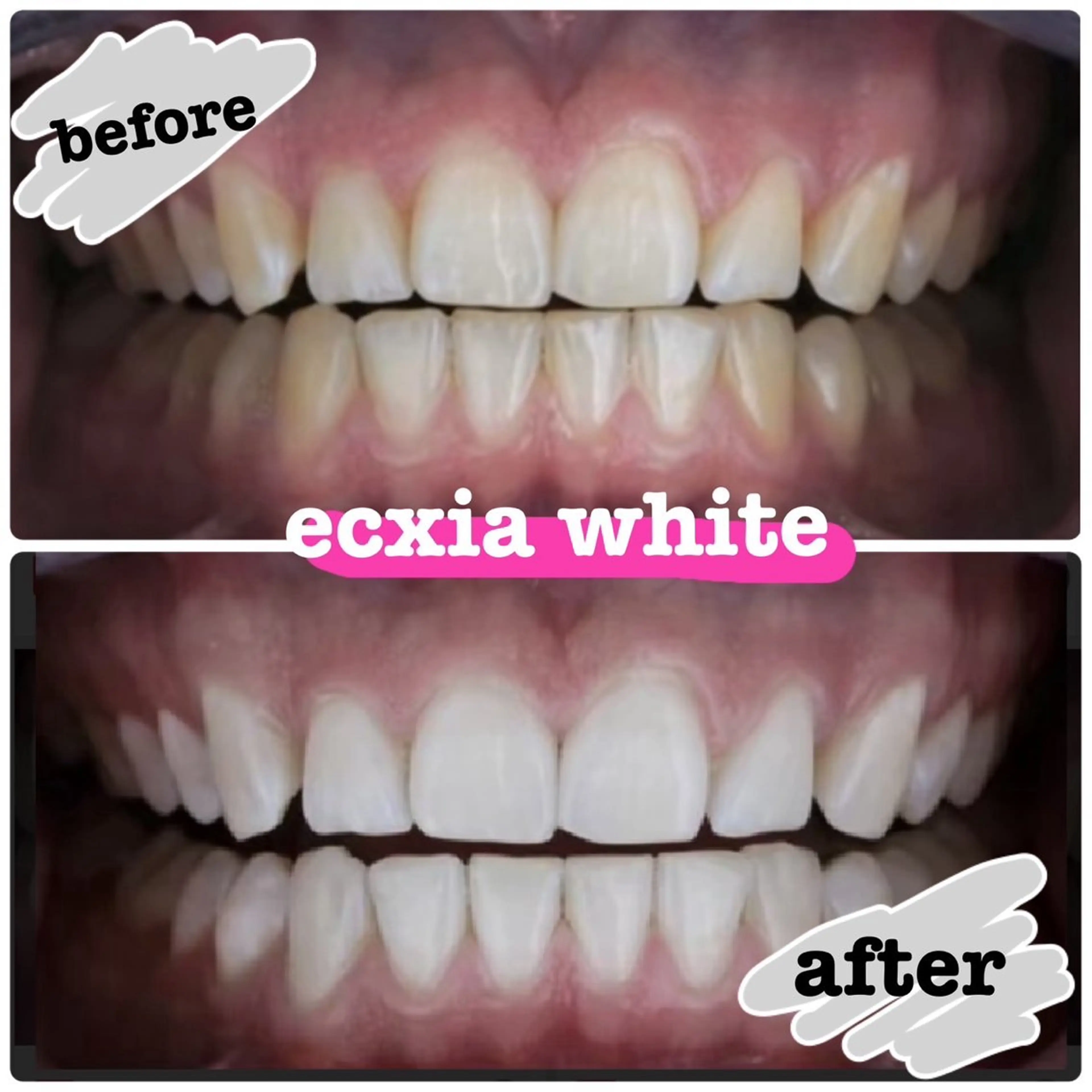 【中央区or日本橋在住／勤務の方限定】地域応援セルフホワイトニングメニュー！★8800→￥1100円の写真