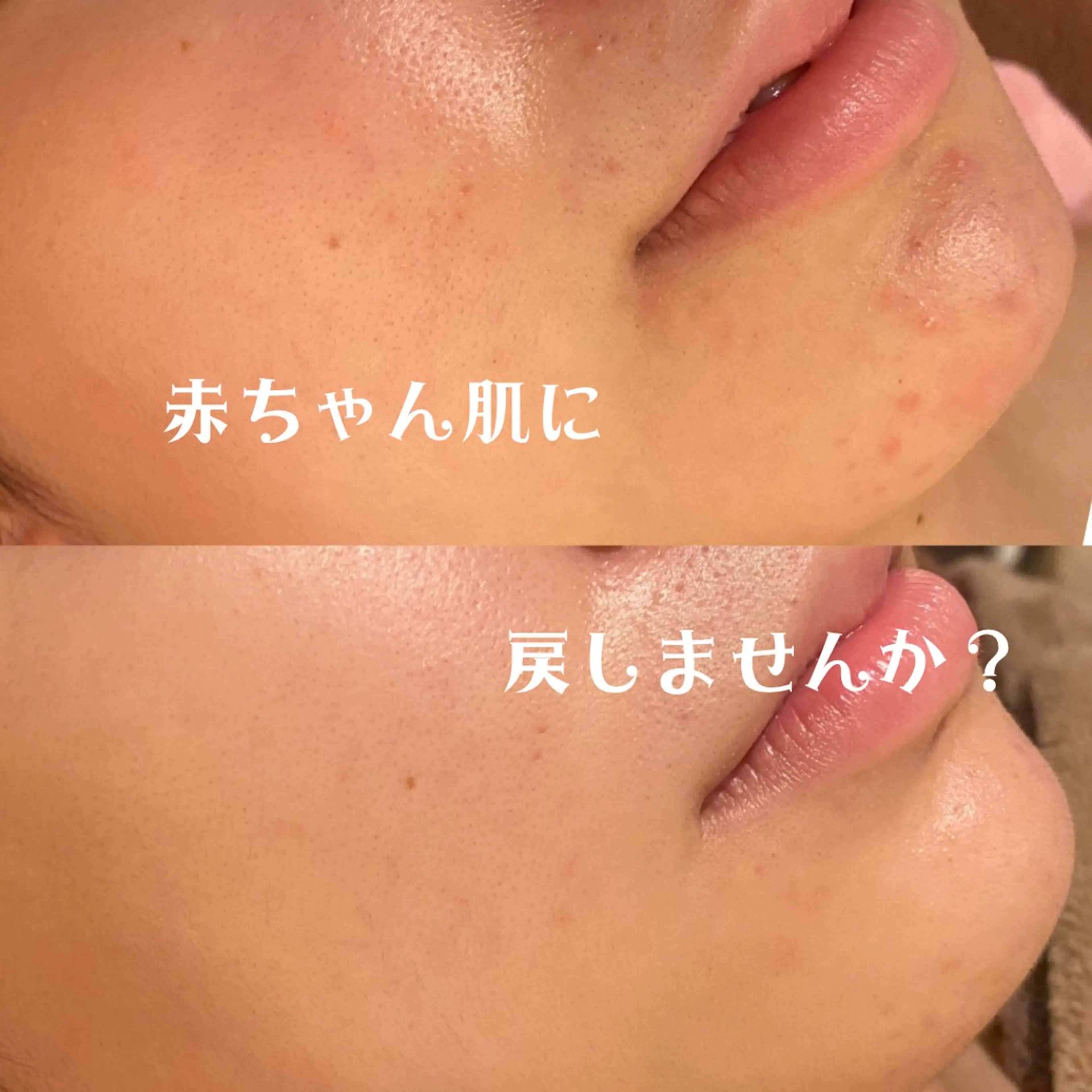 【赤ちゃん肌を取り戻す体験を...💗】長年治らないニキビに特化!フェイシャルエステ&腸もみ&ヘッドスパで最速美肌へ💫の写真