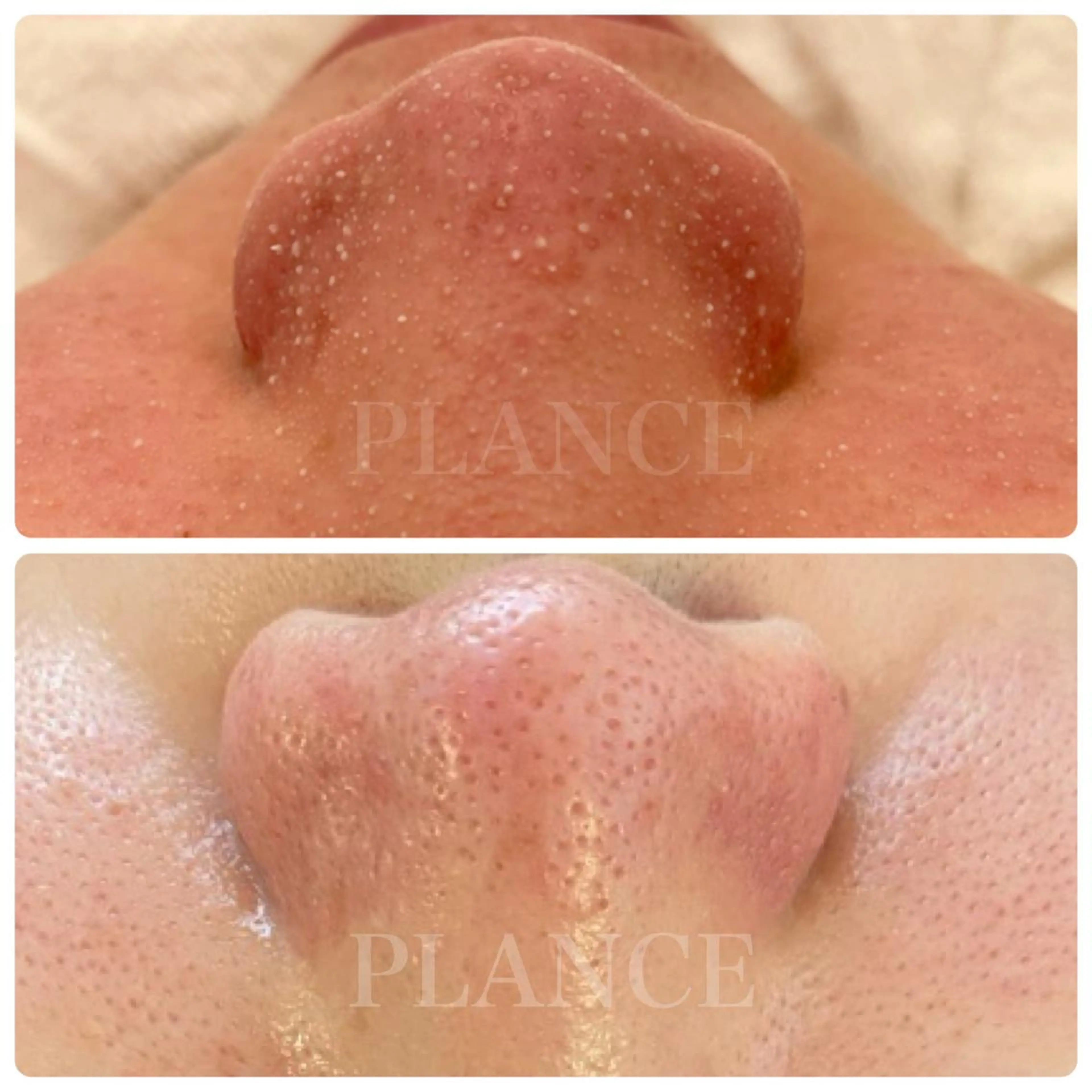 エステ フェイシャル専門 肌質改善/プランスのエステ・リラクイメージ