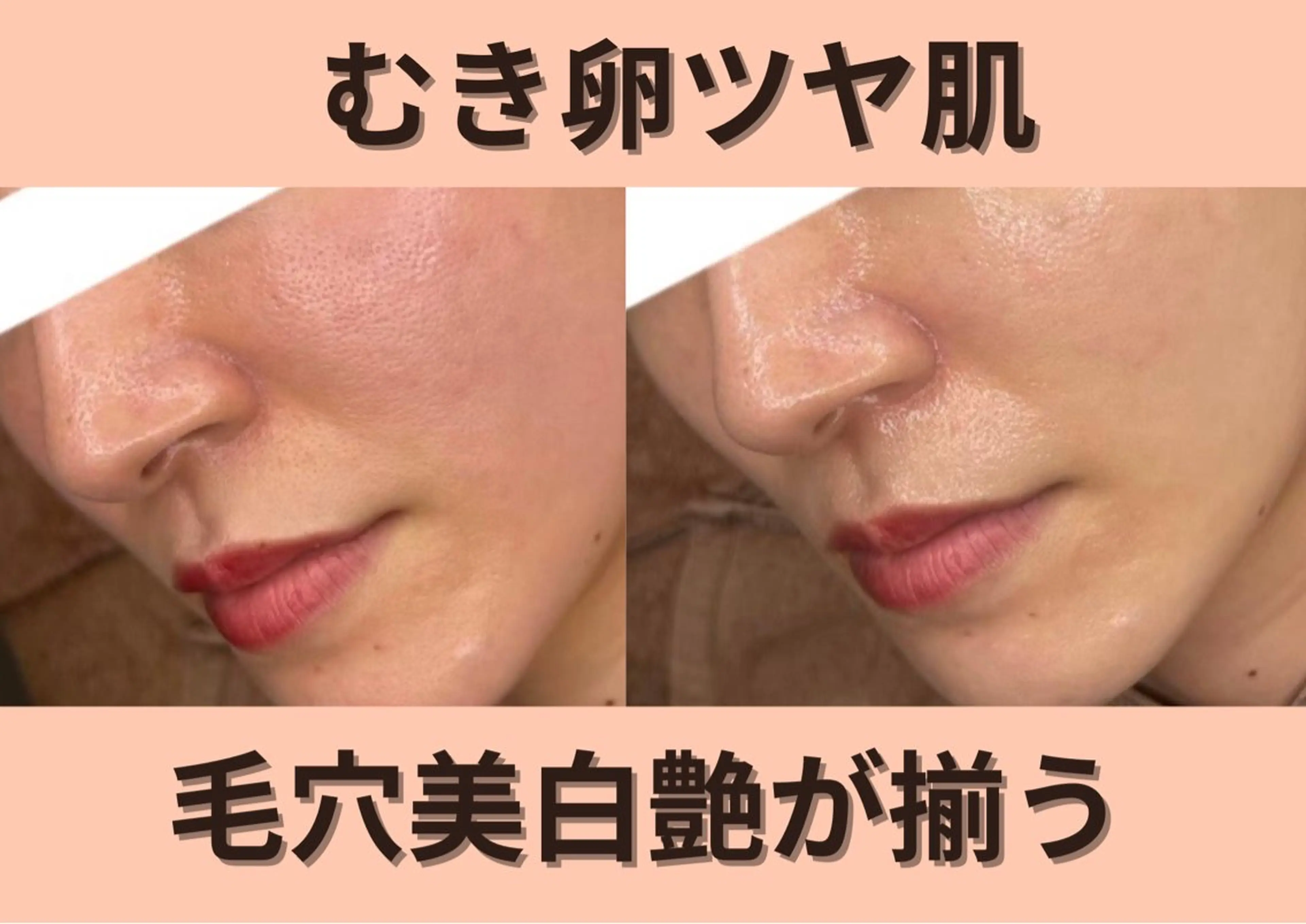 【韓国肌管理🇰🇷卒業・入学前に】ララピールで透明感UP！くすみニキビ乾燥肌荒れ◎の写真