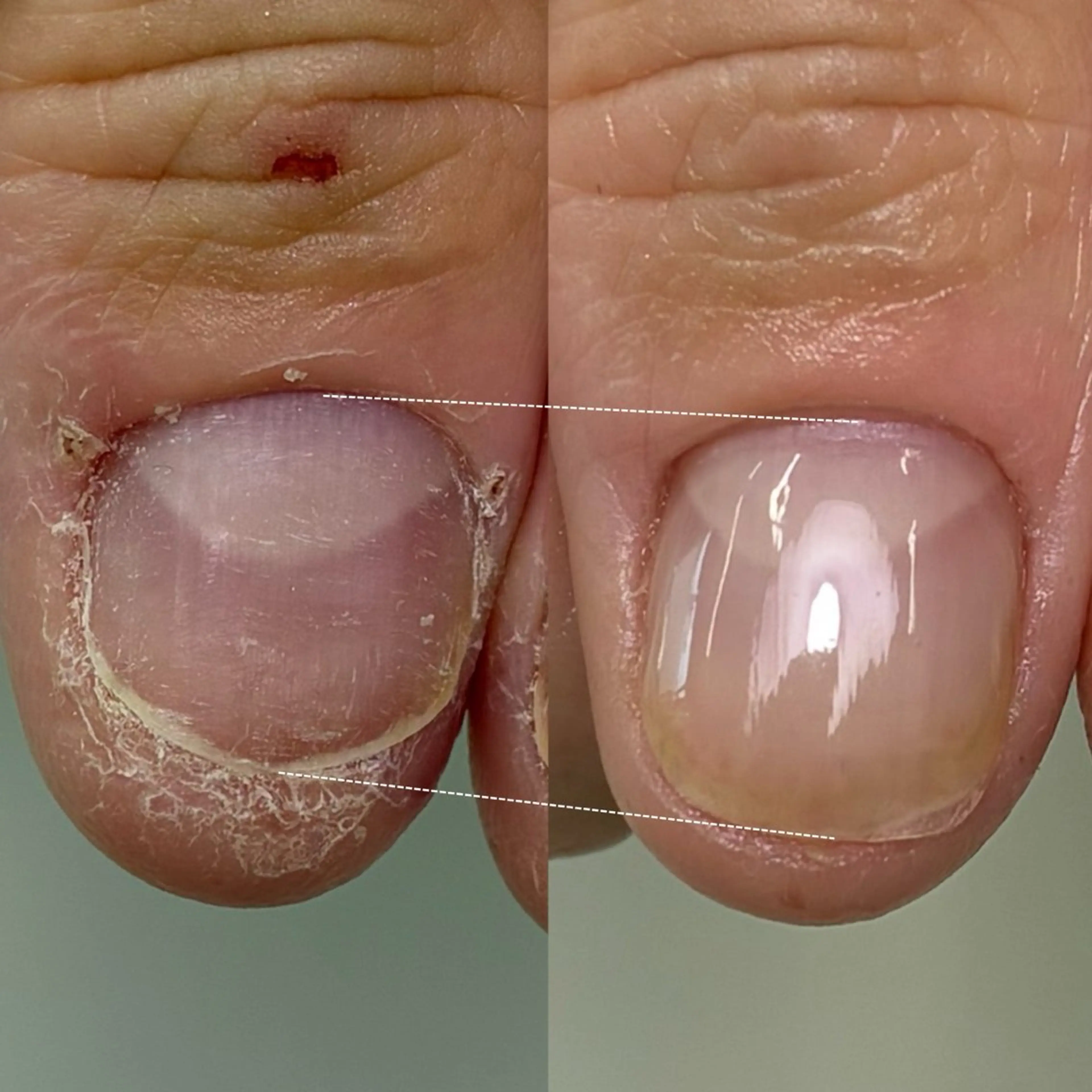 ネイル ハンドネイル ハンドケア 広島市南区(広島県) /深爪/自爪育成のネイルデザイン