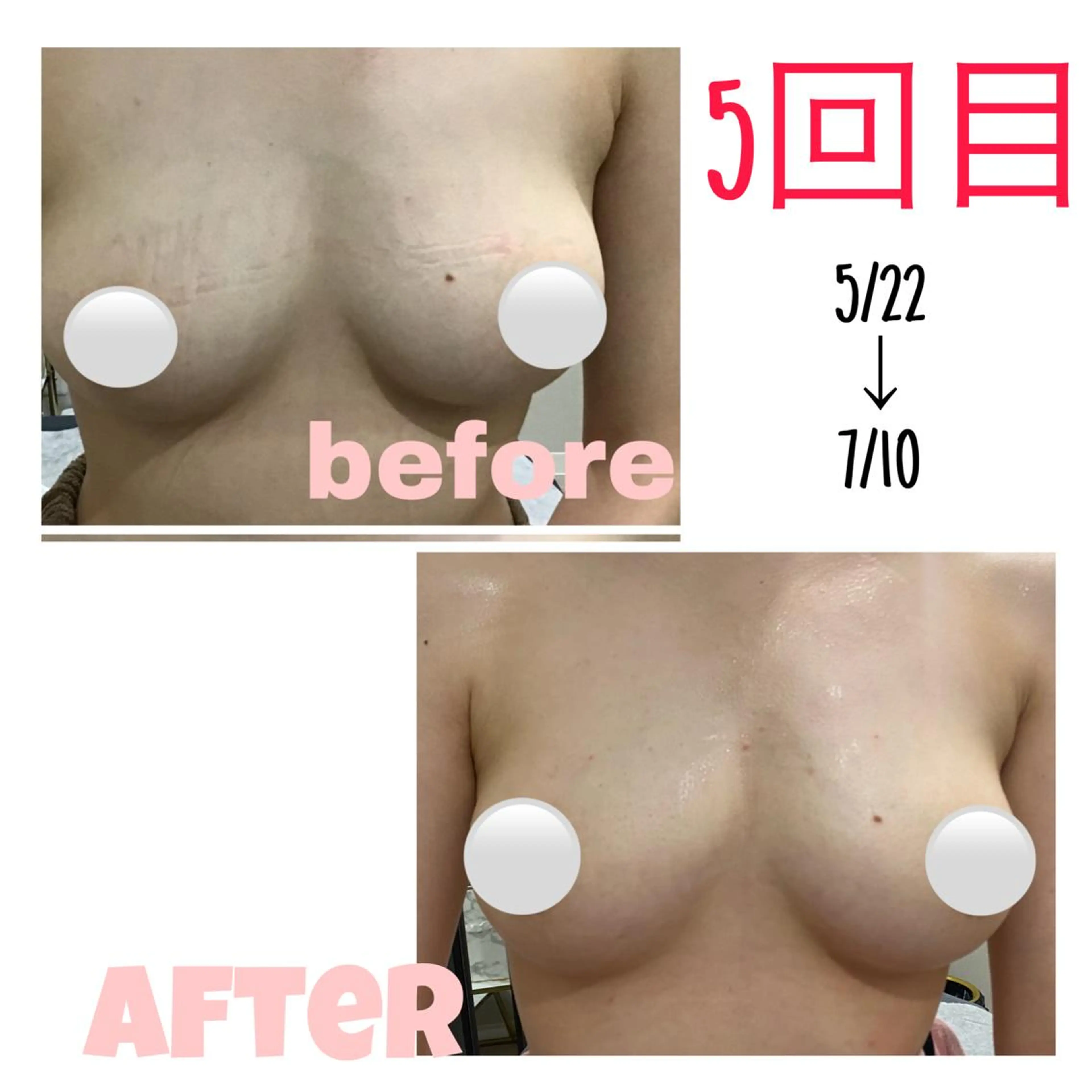 【女性】ご新規様🐠バストアップメニュー💖光施術＋マッサージの写真