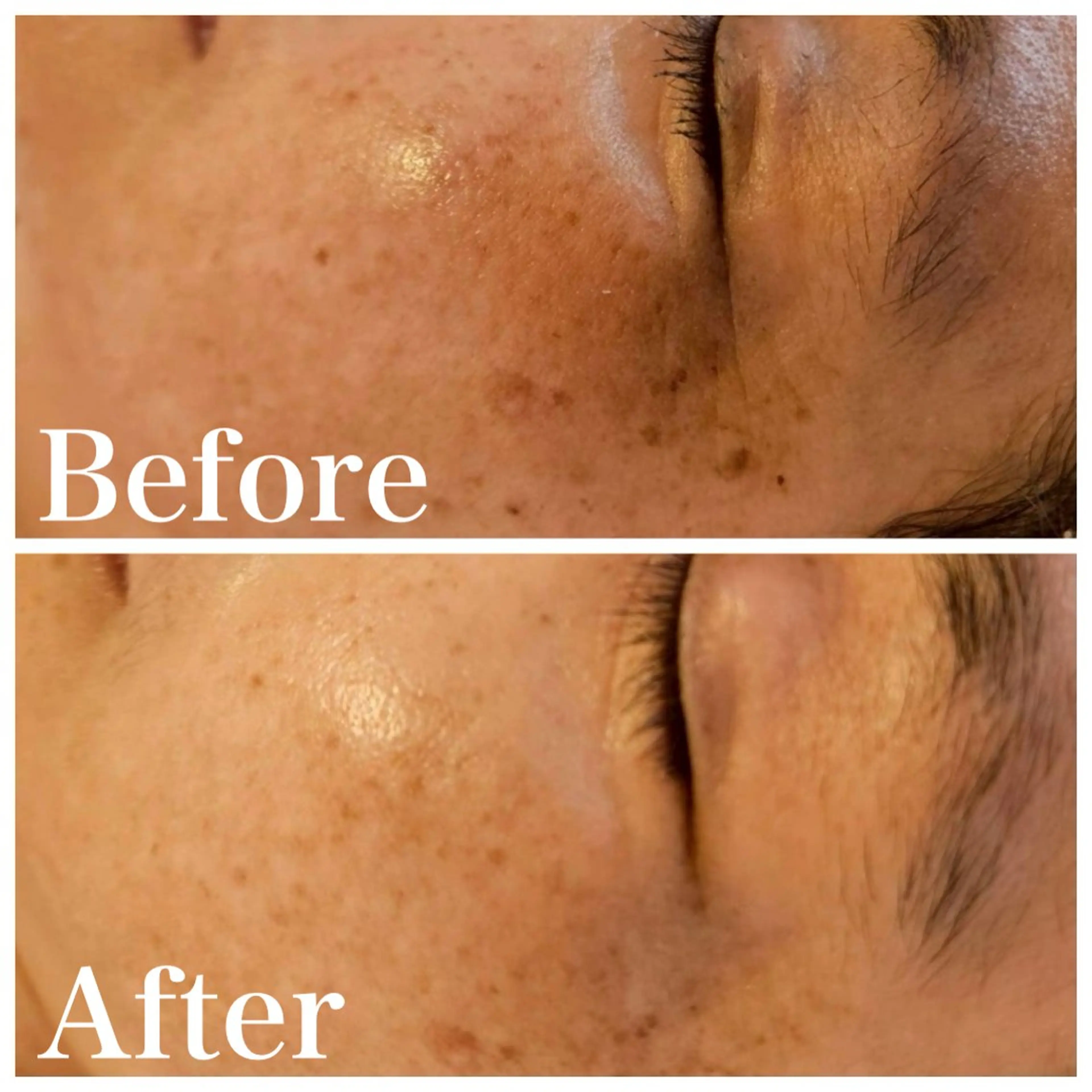 【再来様専用】ハーブピーリング剥離ありの写真