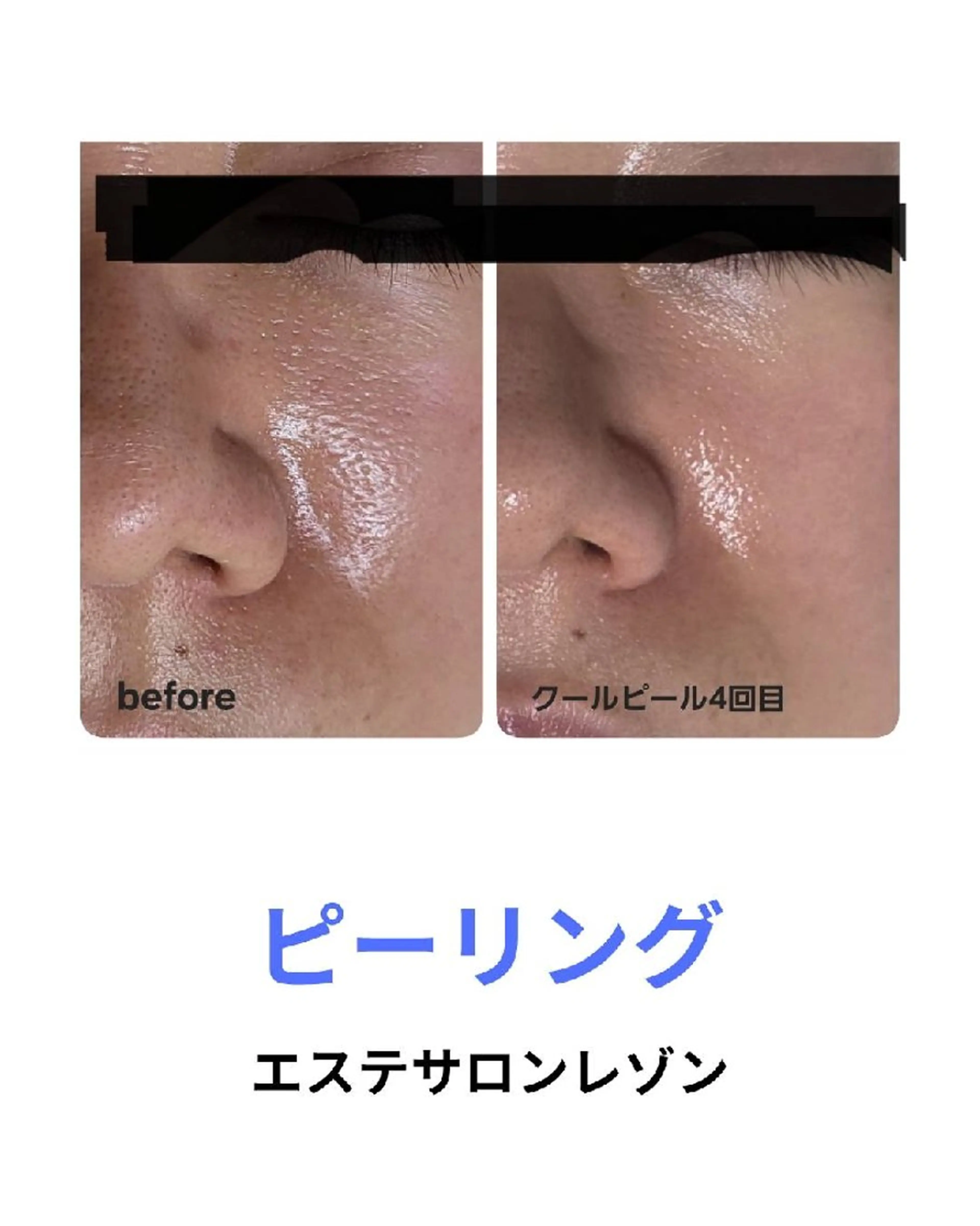 〈ニキビケアサロン〉 レゾン京橋店/ 浅川のエステ・リラクイメージ