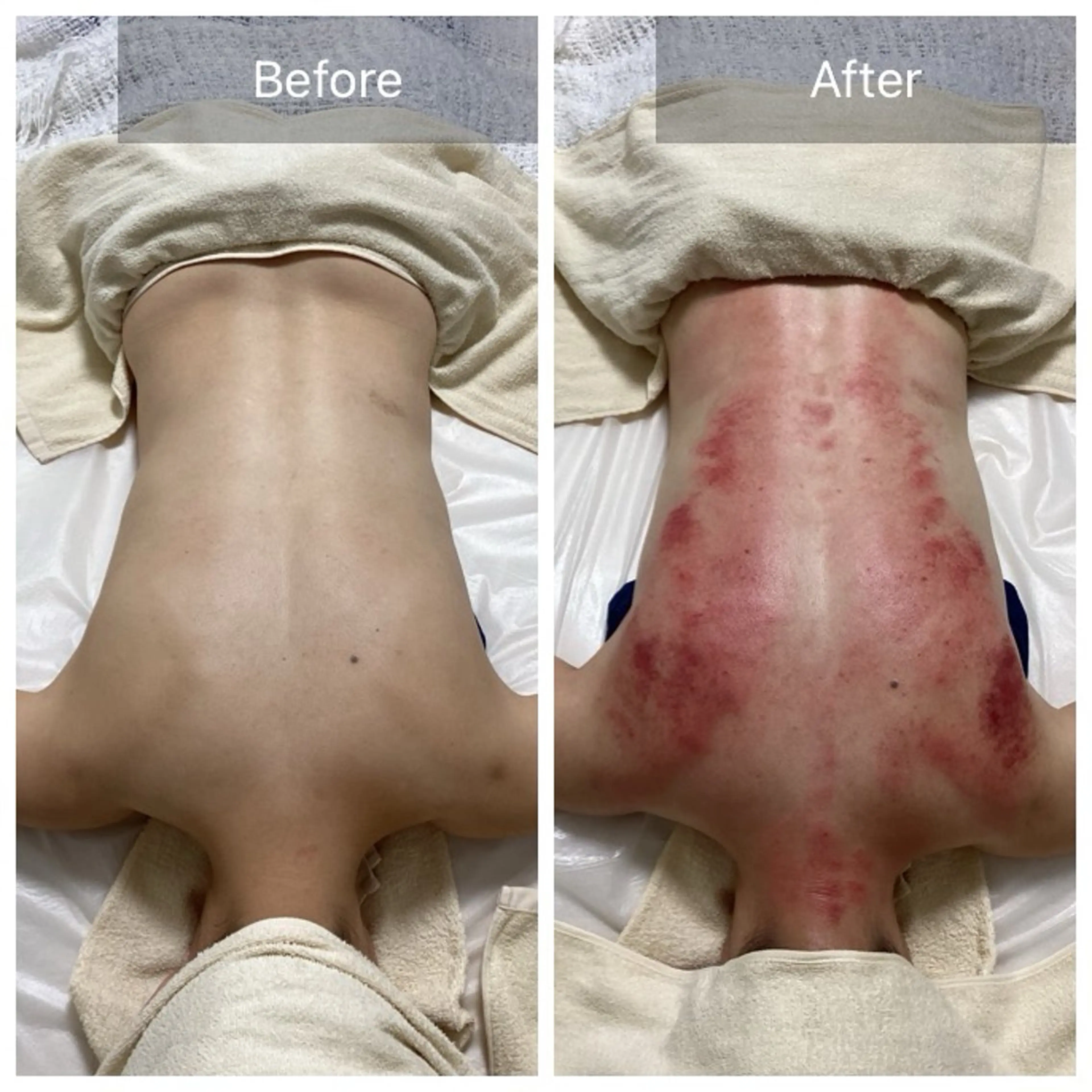 【肩こり/慢性疲労/背中のコリ/むくみ】ガチガチ背中カッサ＋背中コルギ40分の写真