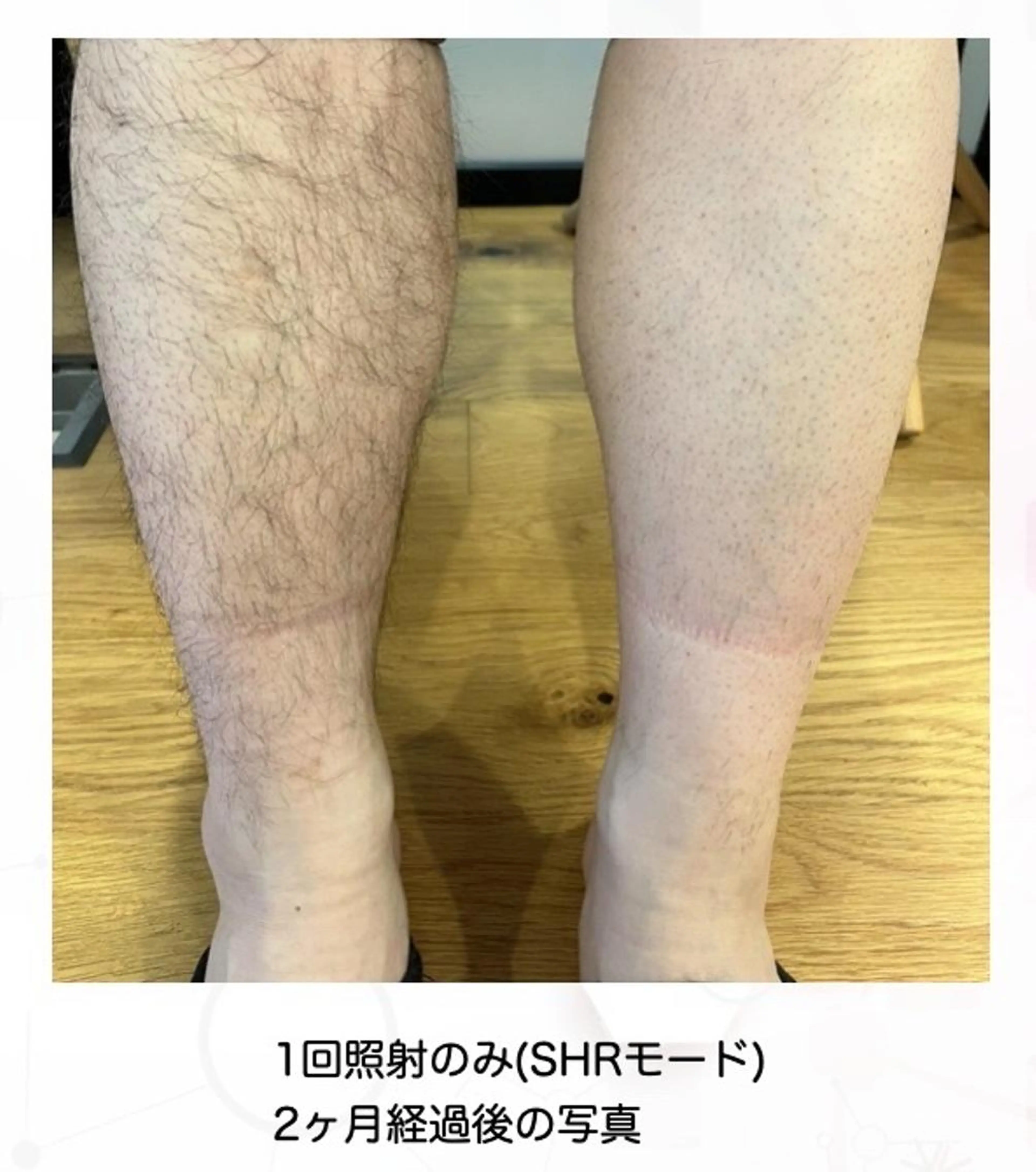 ≪第一印象がかわる！≫メンズ全身脱毛+ヒゲ脱毛🌸【完全都度払い】の写真