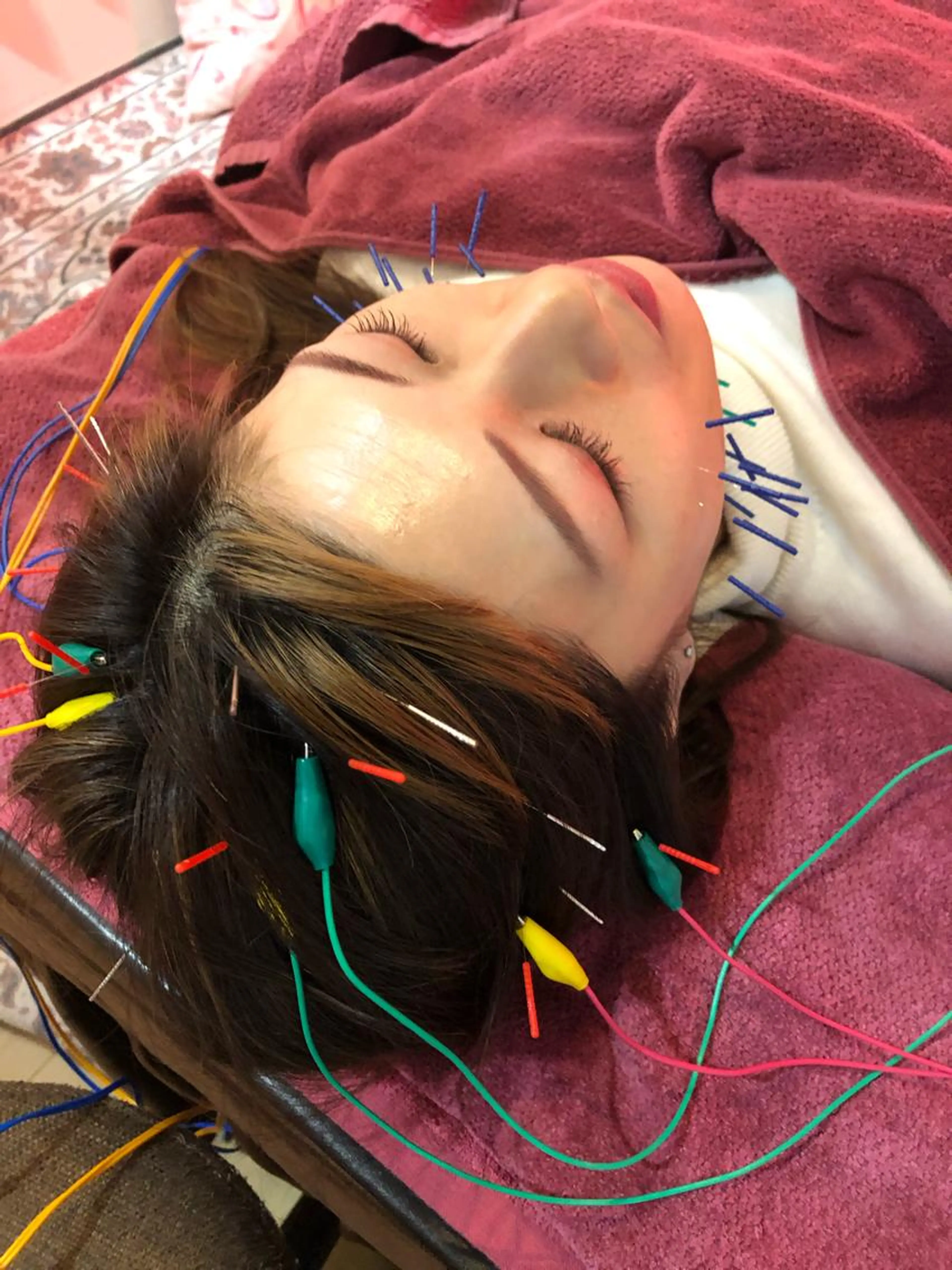 ☆美顔鍼＆電気鍼お任せコース※メイクされたままでokです^ ^の写真