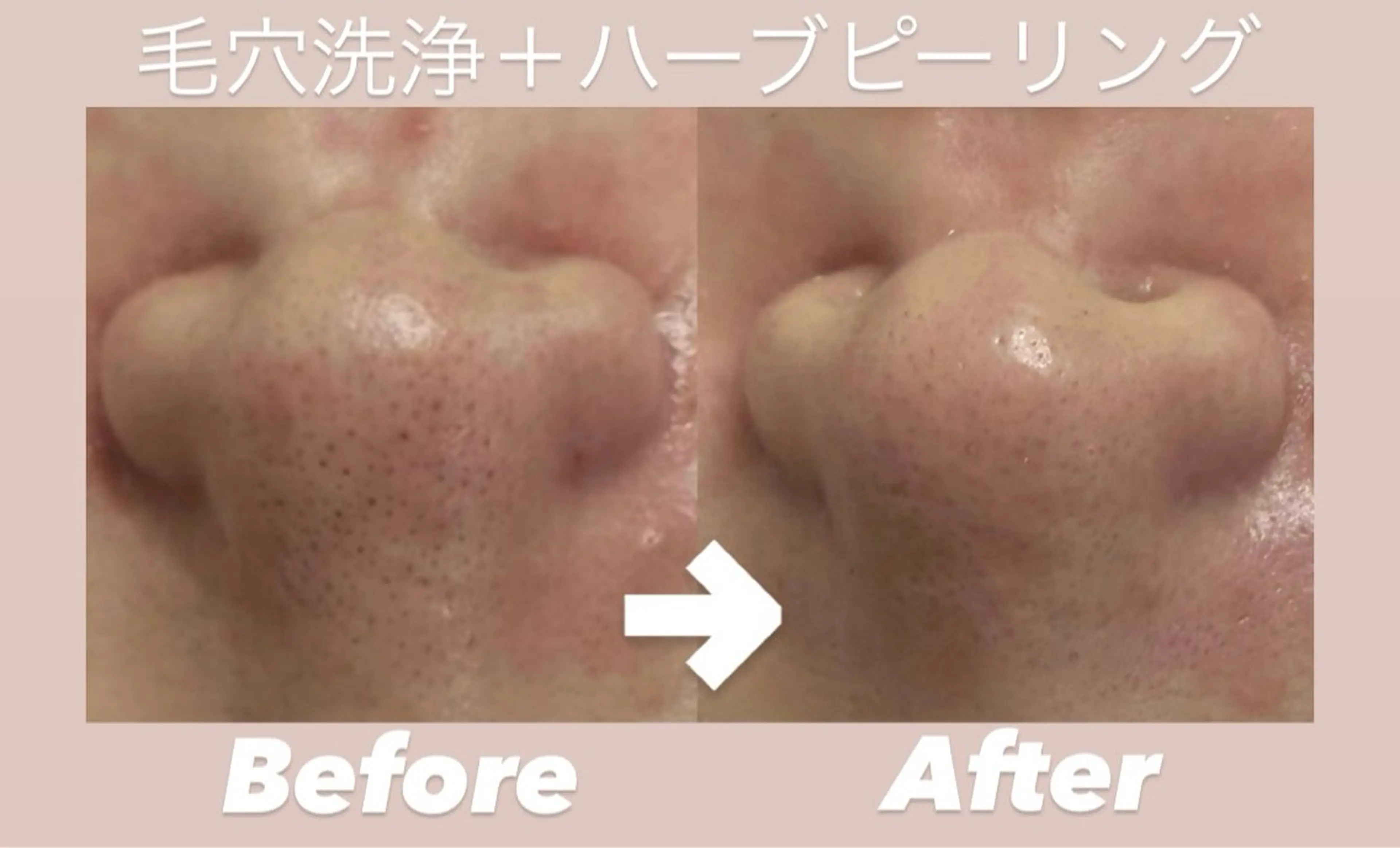 🌟ご新規様限定🌟【毛穴洗浄＋ハーブピーリング】　黒ずみ/開き毛穴汚れスッキリ！ツルツルで触りたくなるお肌へ🪞✨の写真