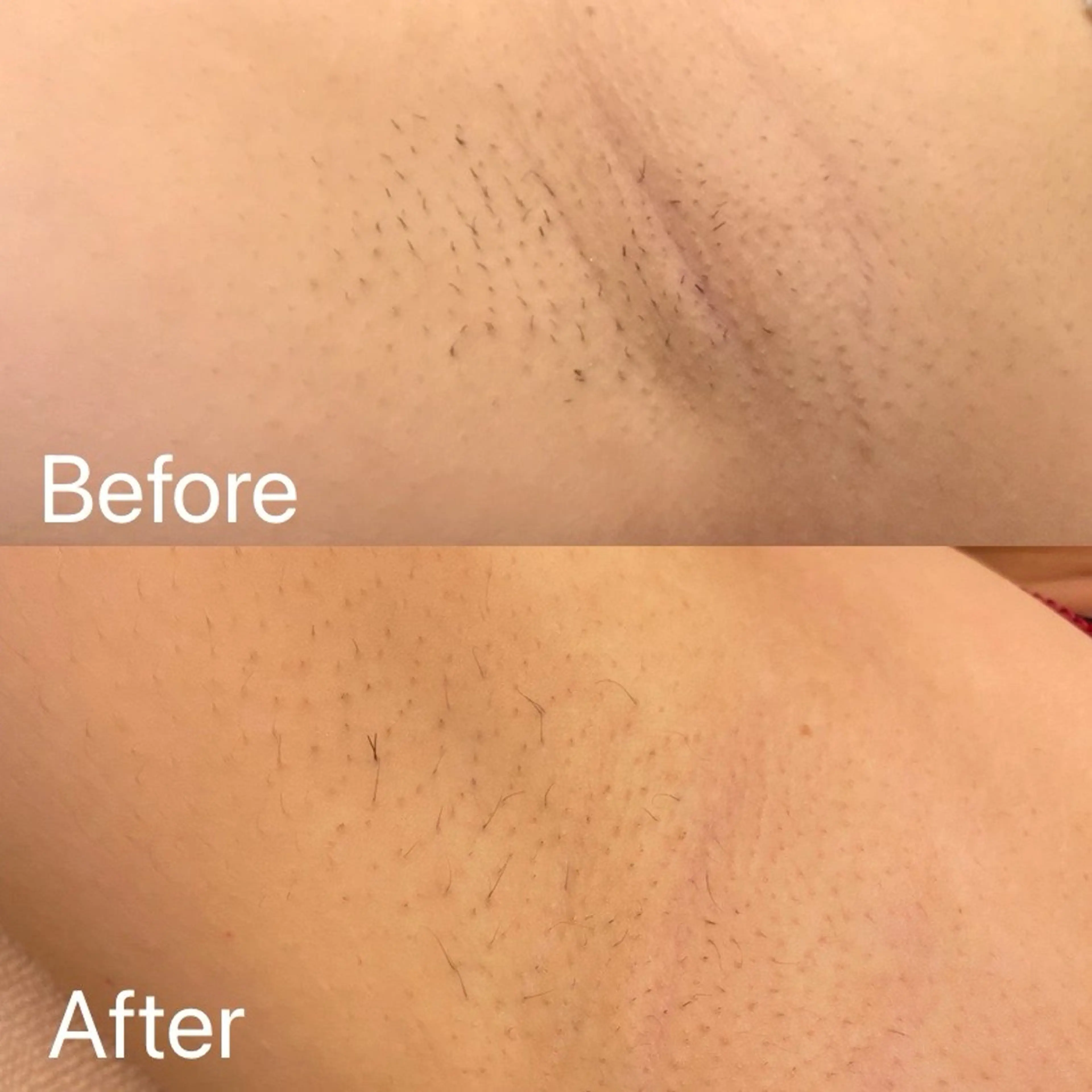 脱毛 Dione自由が丘 山下有香子のエステ・リラクイメージ