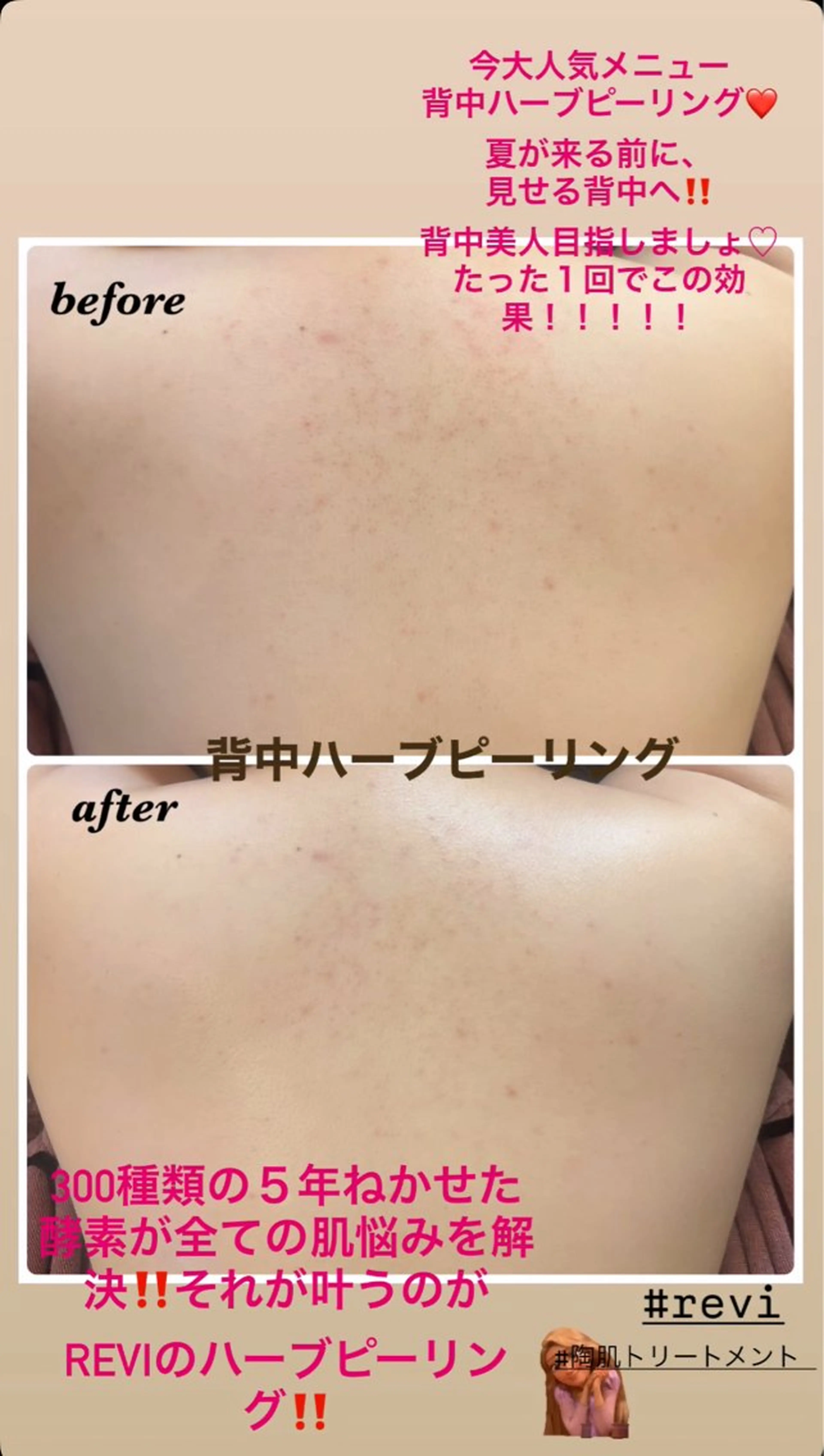 エステ ハーブピーリング専門 毛穴洗浄❤️眉waxのエステ・リラクイメージ