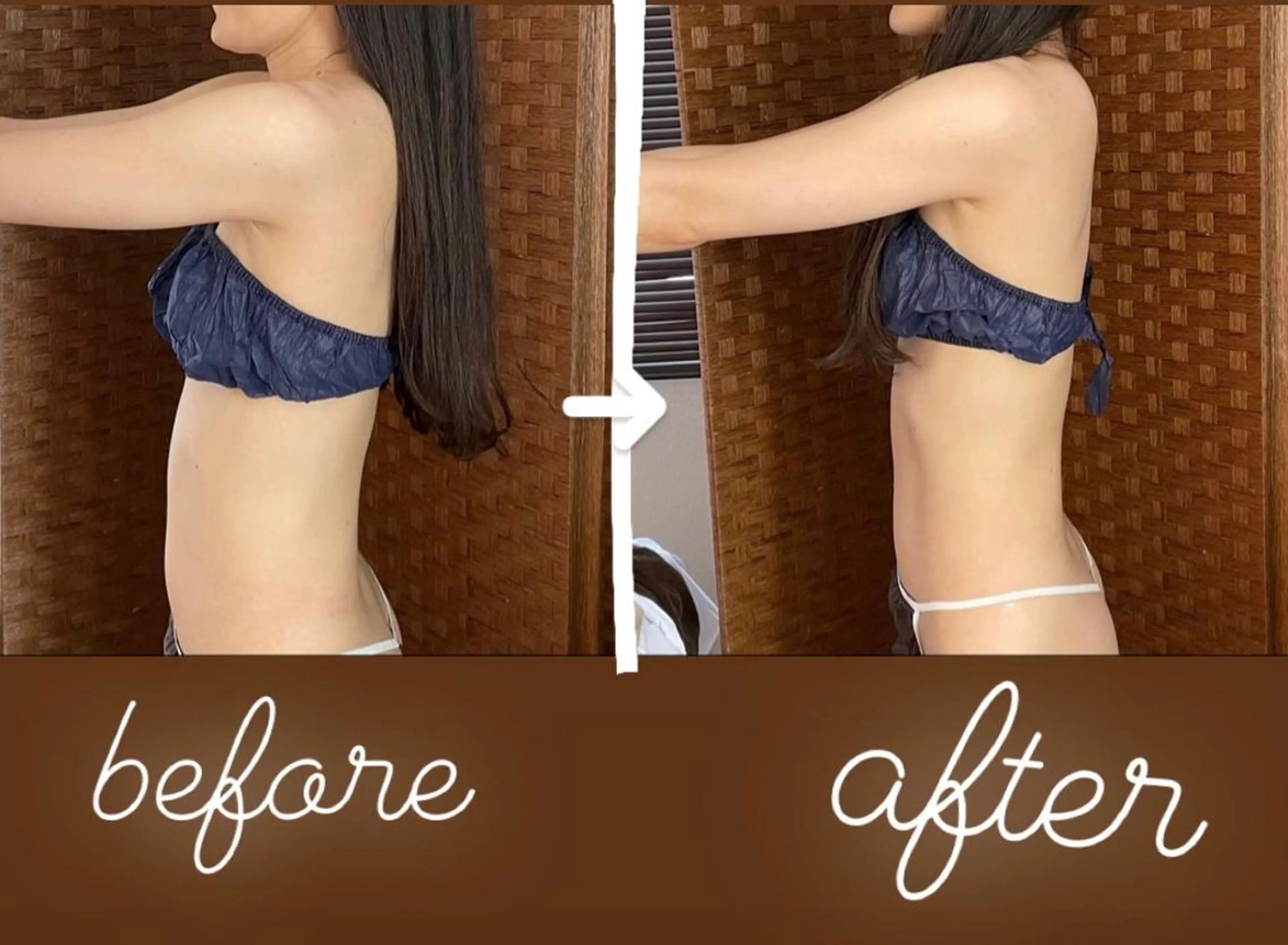 大人気✨ハイパーナイフ女優肩二の腕集中痩せコースの写真