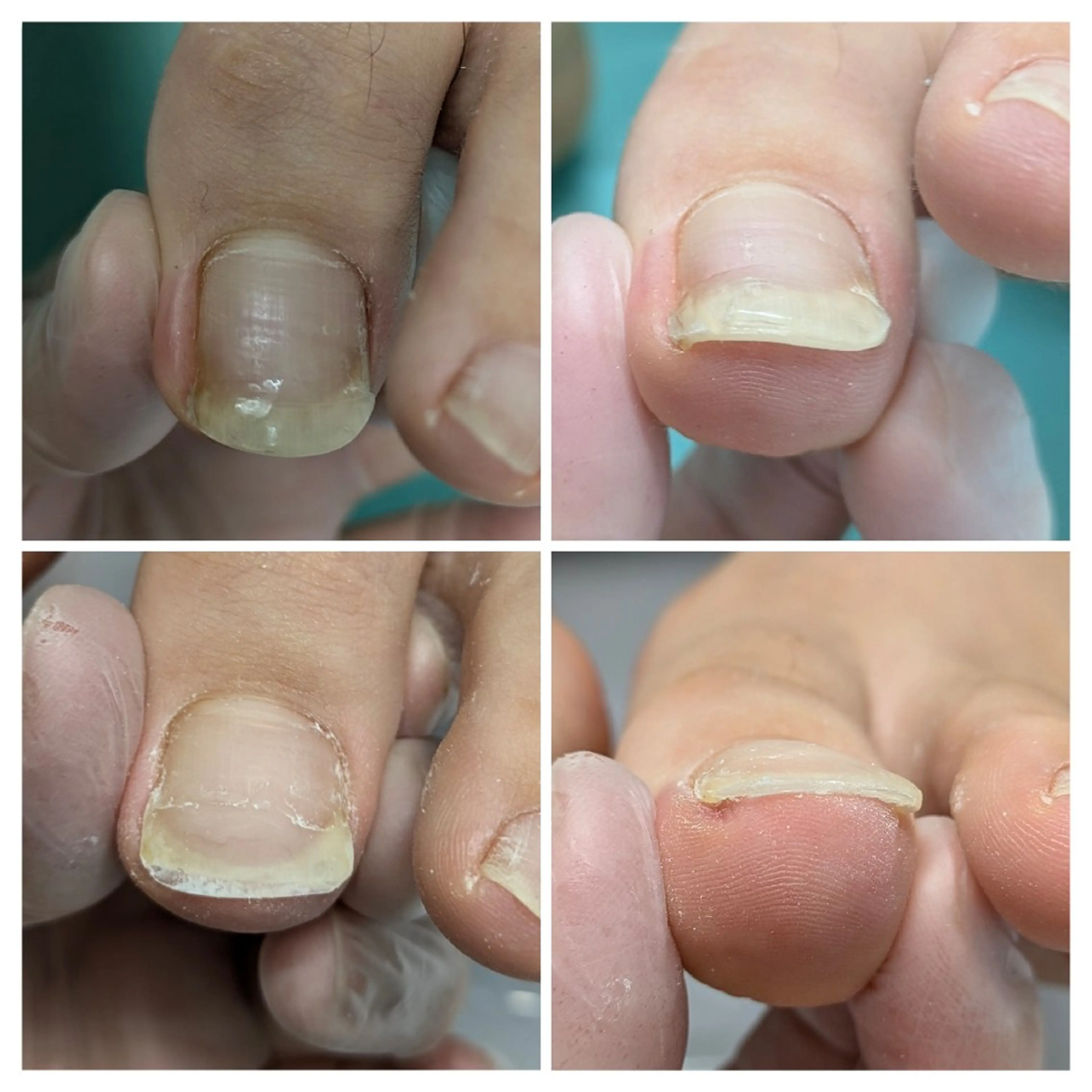 巻き爪補正店 大阪なんば店のネイルデザイン