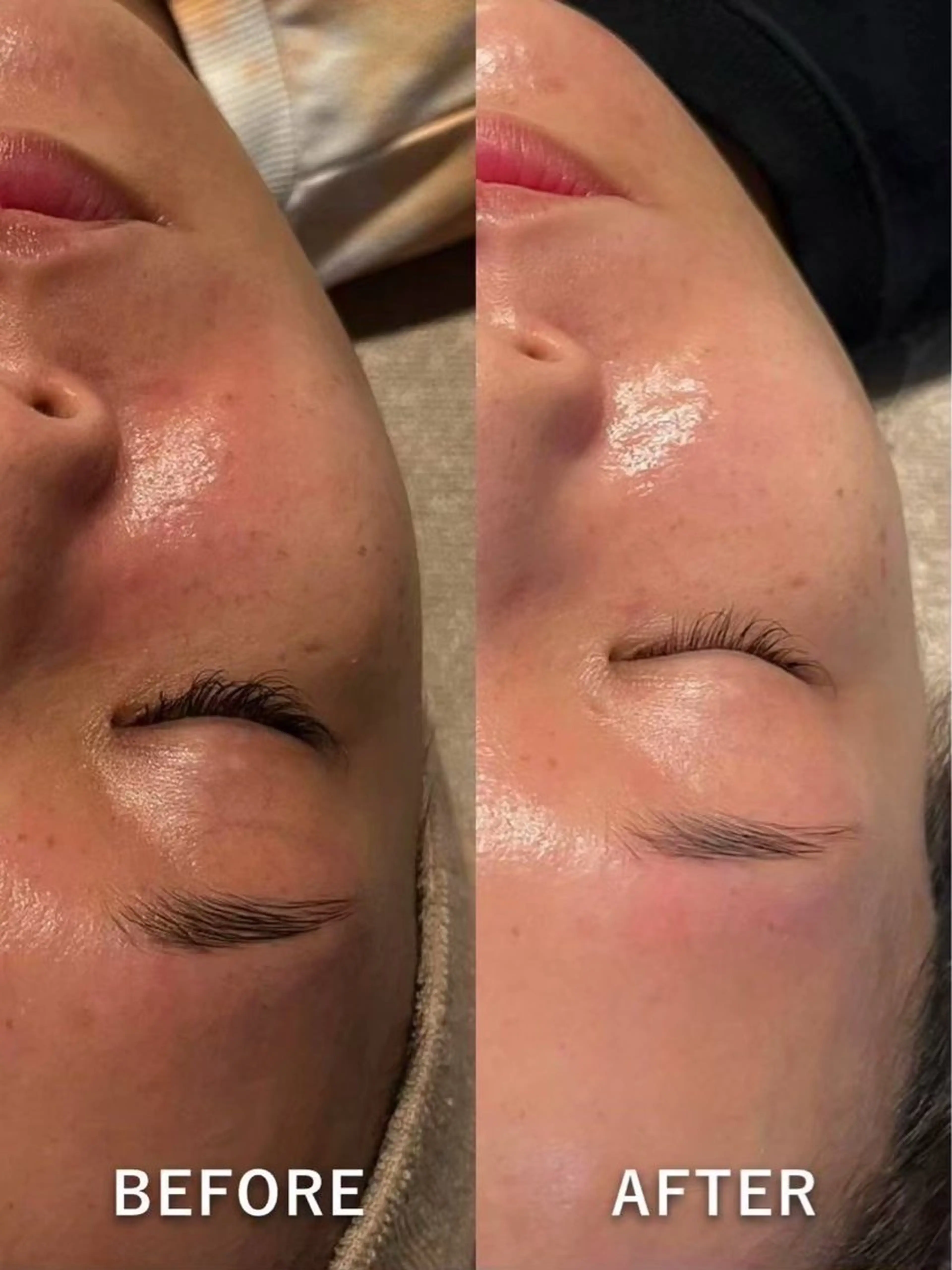 【シミそばかす改善⚡️】光フェイシャルの写真