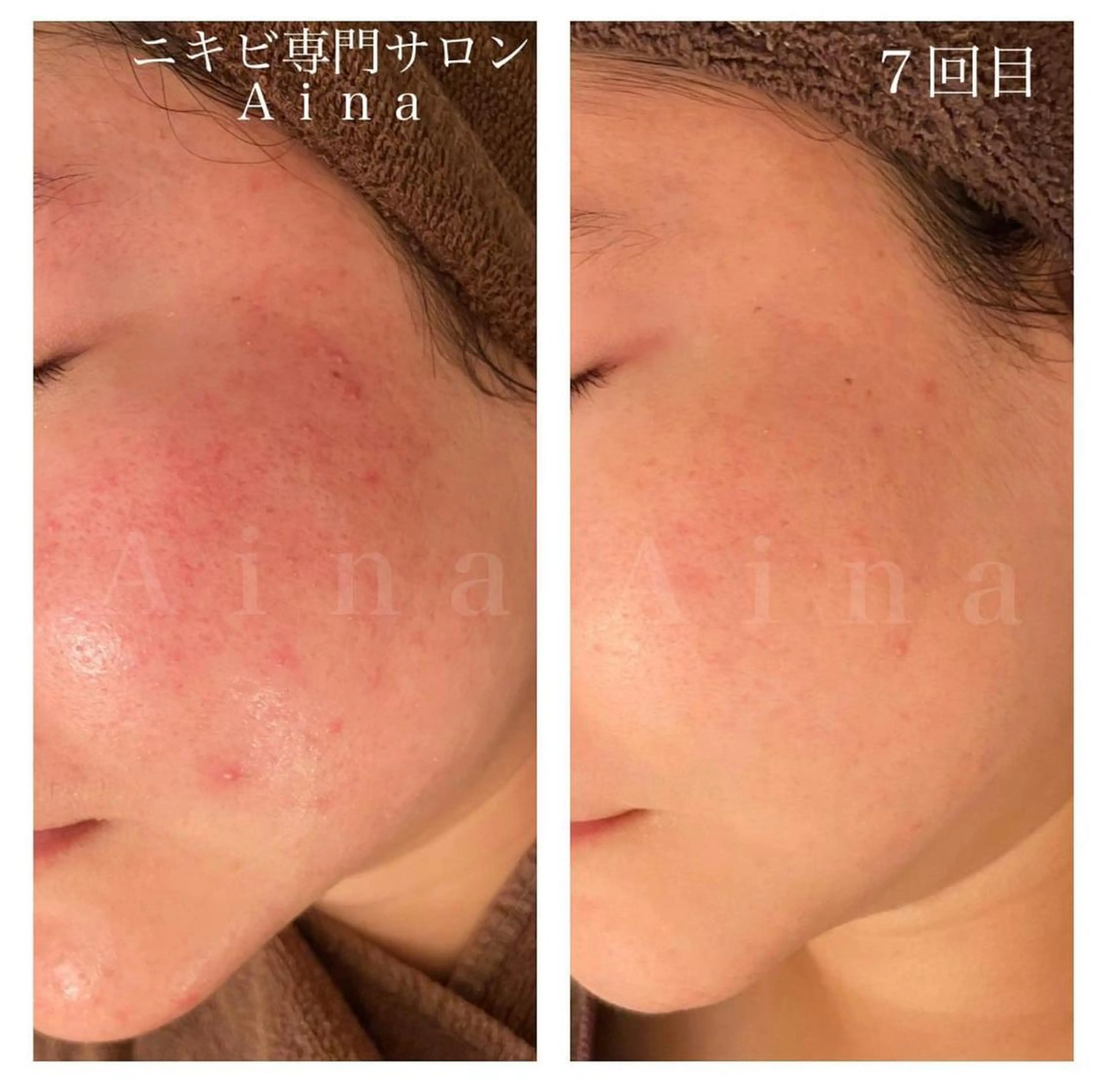 セミロング パーマ ヘアアレンジ メンズ キッズ ネイル マツエク・マツパ アイブロウ 学生（メンズ向け） 卒業式のヘアスタイル 学生 卒業式 赤色 エステ リラク ニキビ跡専門サロン Ａｉｎａのエステ・リラクイメージ