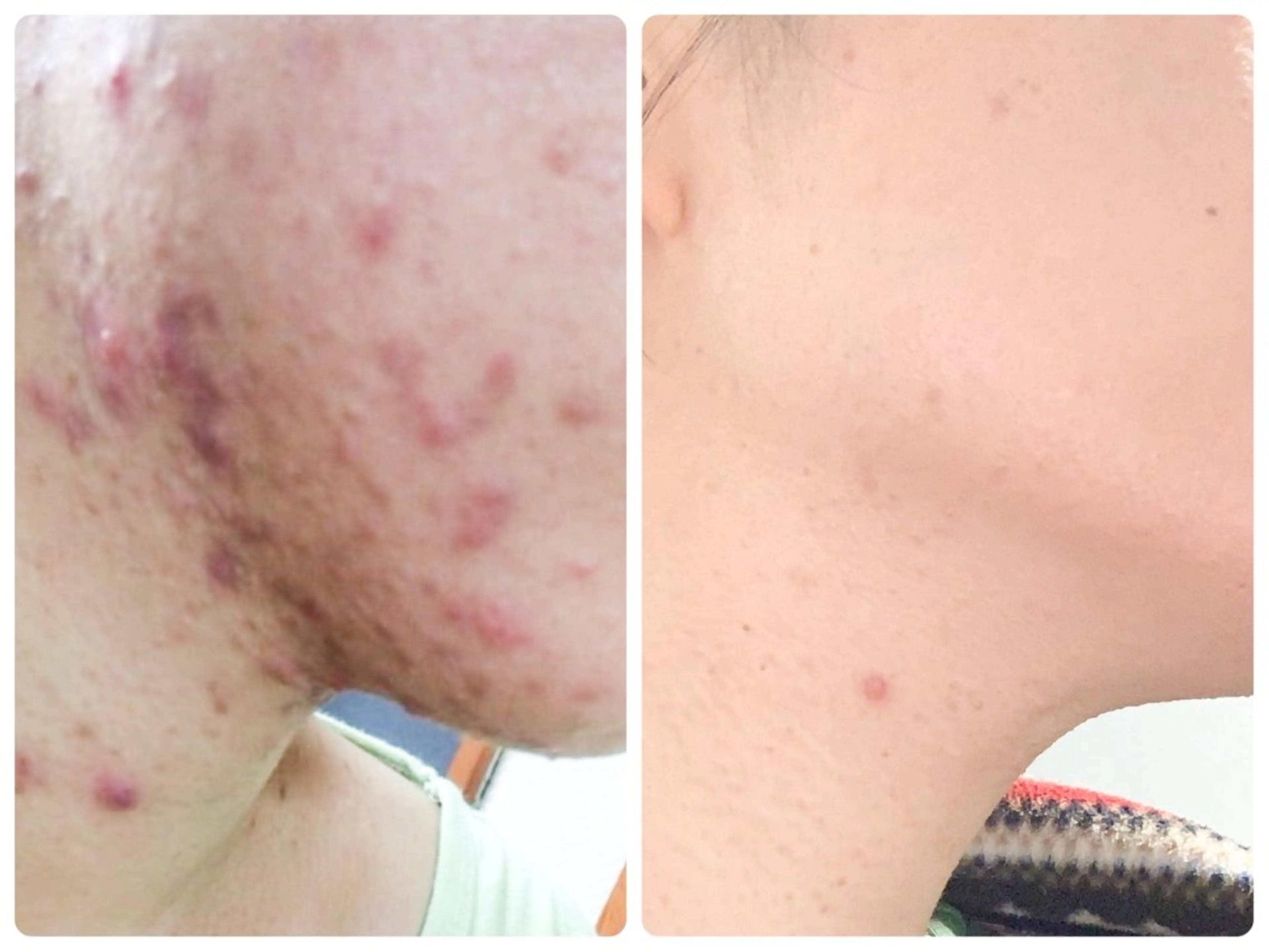 ニキビなのかニキビ跡なのか迷っている方✨肌荒れ相談歓迎🎊の写真