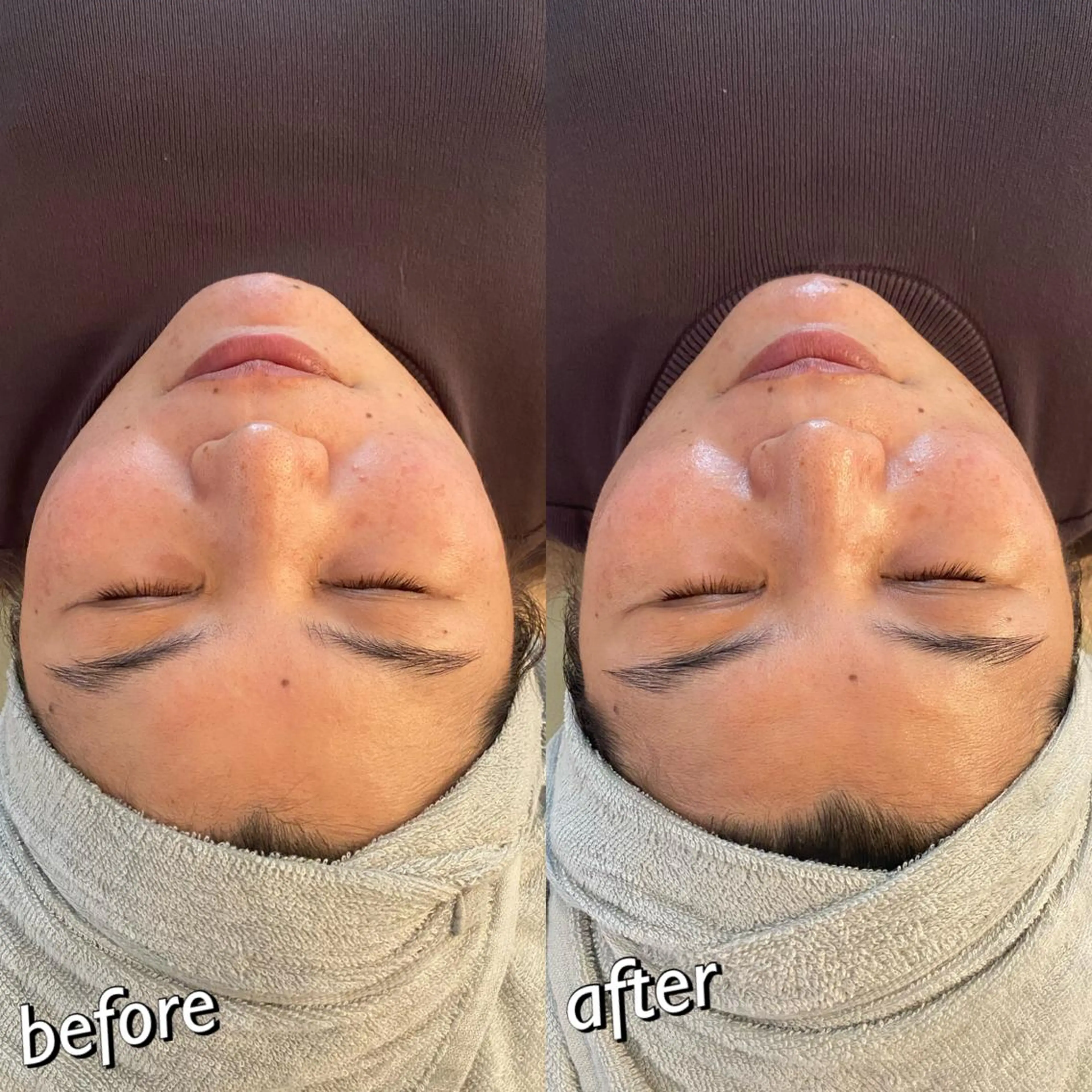 うなじ脱毛/美肌脱毛 LABELのエステ・リラクイメージ